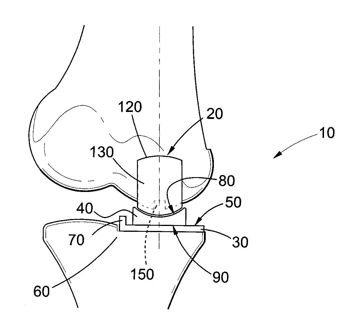 Orthopedic Prosthesis