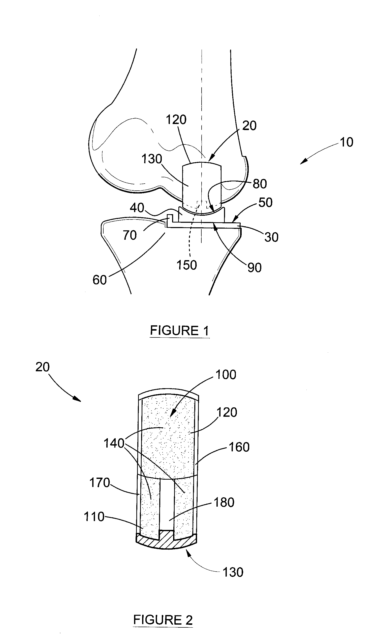 Orthopedic Prosthesis