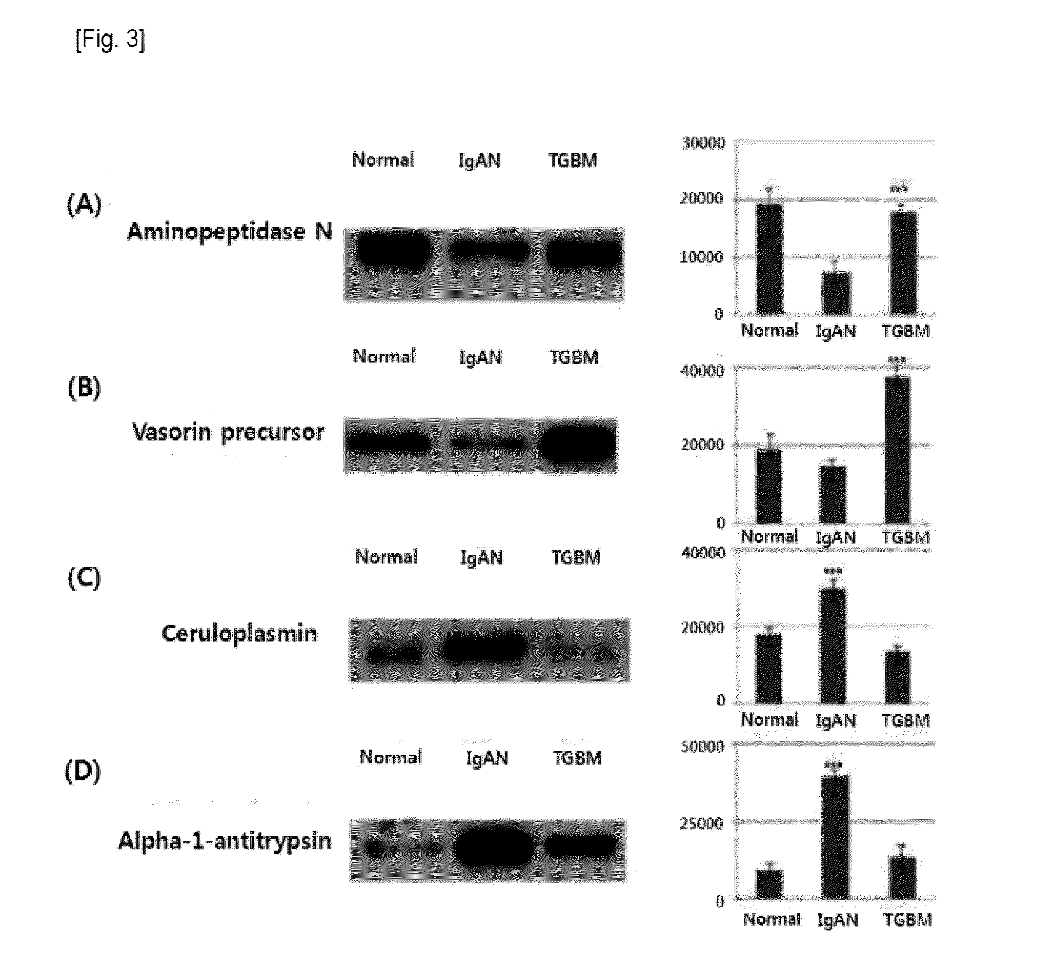 Compostion and kit for diagnosing immunoglobulin a nephropathy and TGBM nephropathy