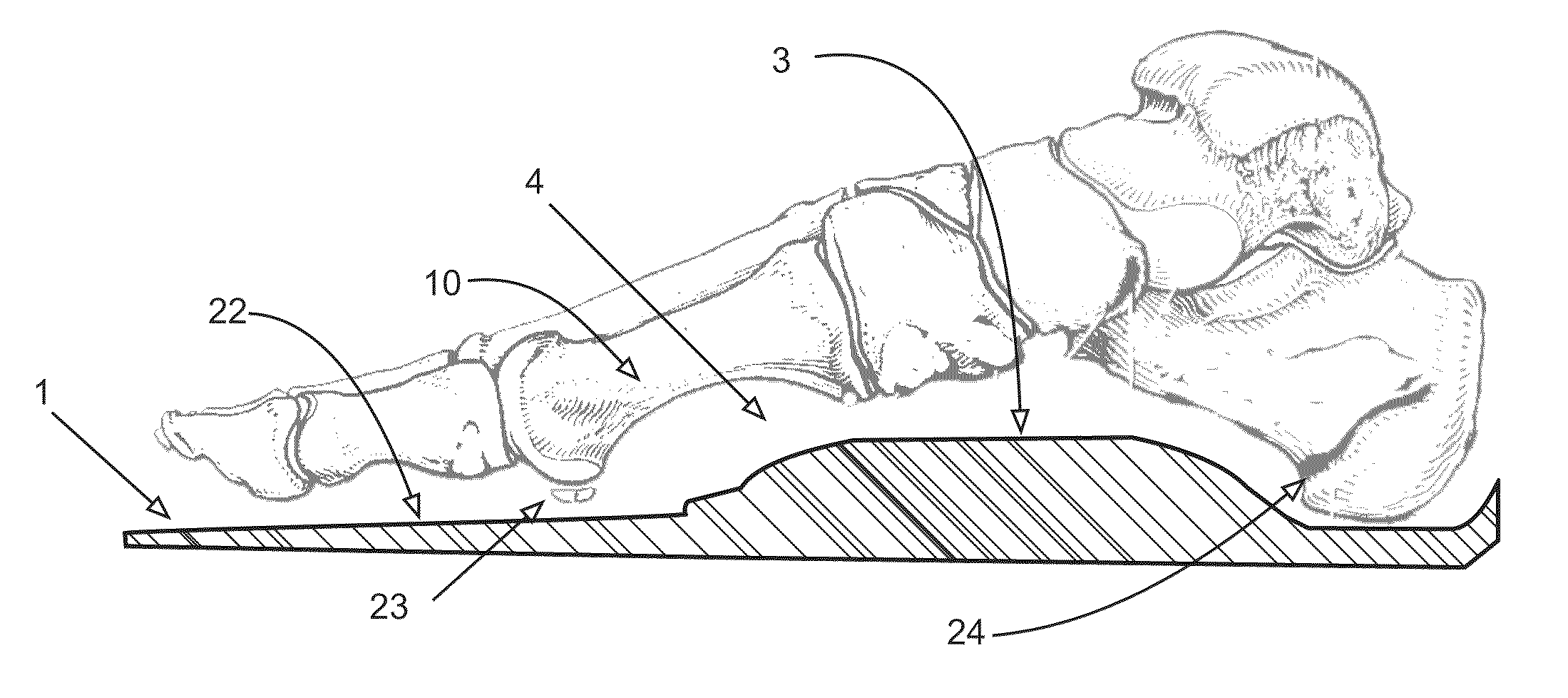 Motion control insole with muscle strengthening component