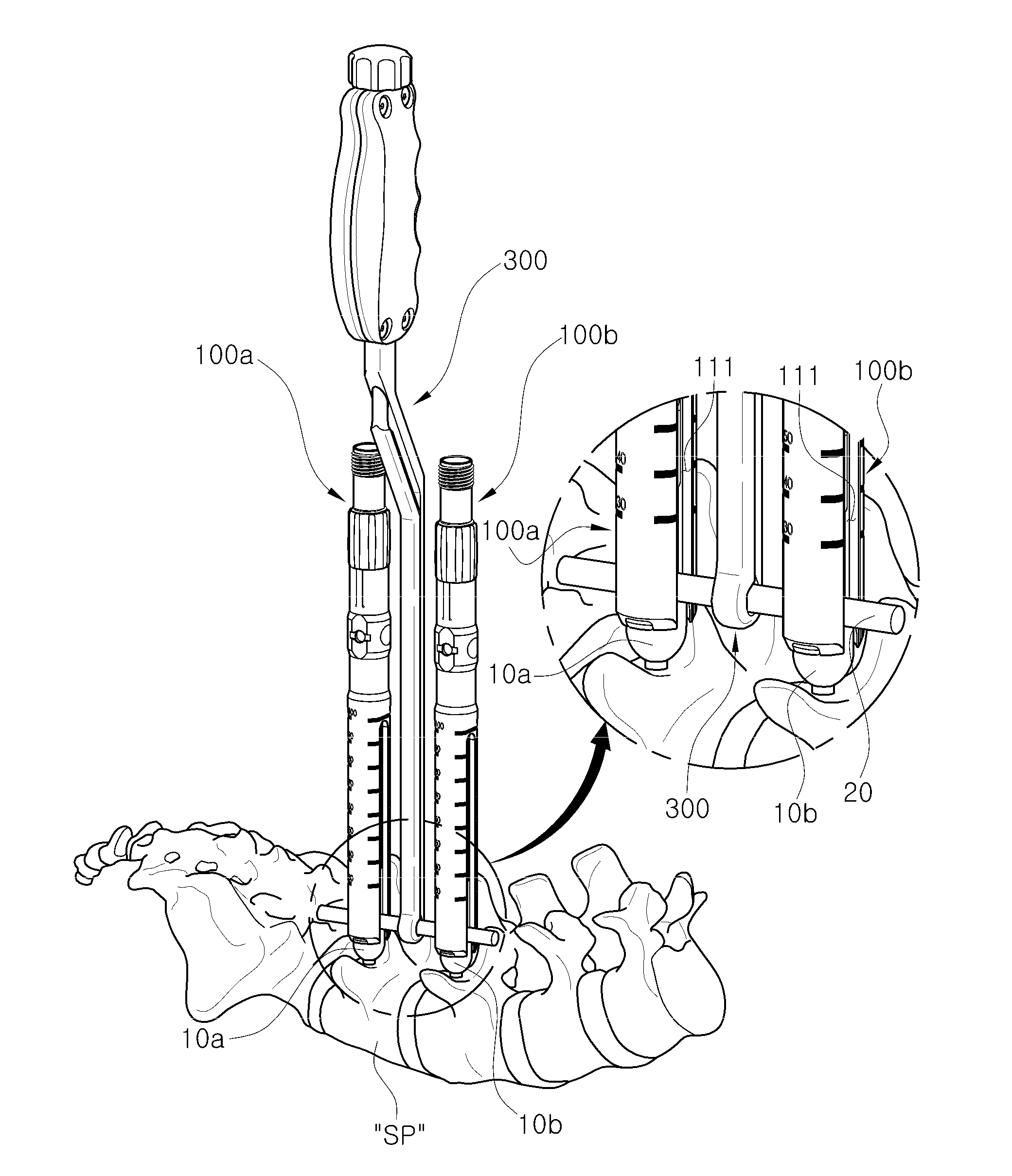 Working tower, rod inserter, rod reducer, and compression-distraction tool for minimally invasive surgery system