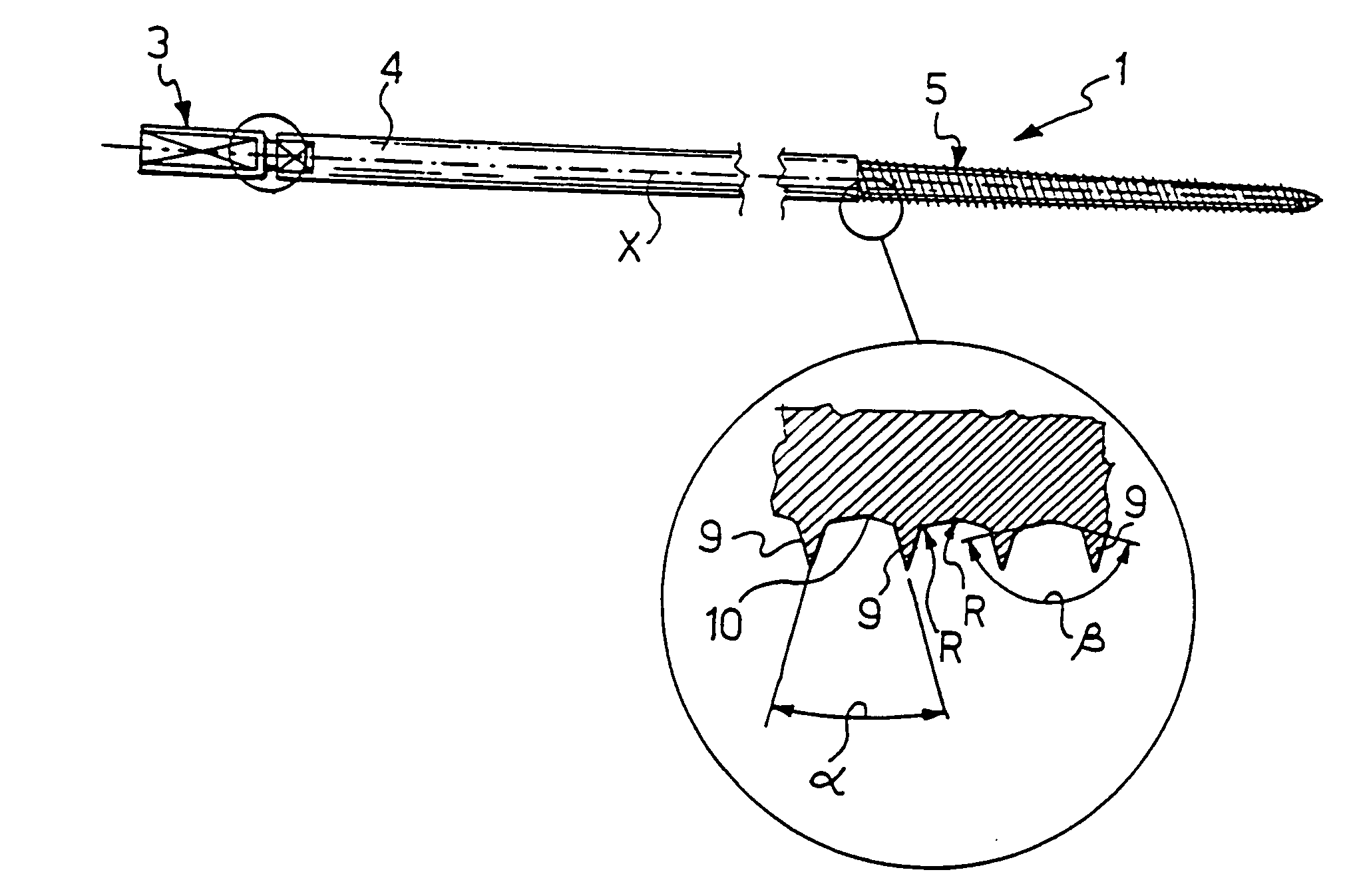 Bone screw for use in orthopaedic surgery