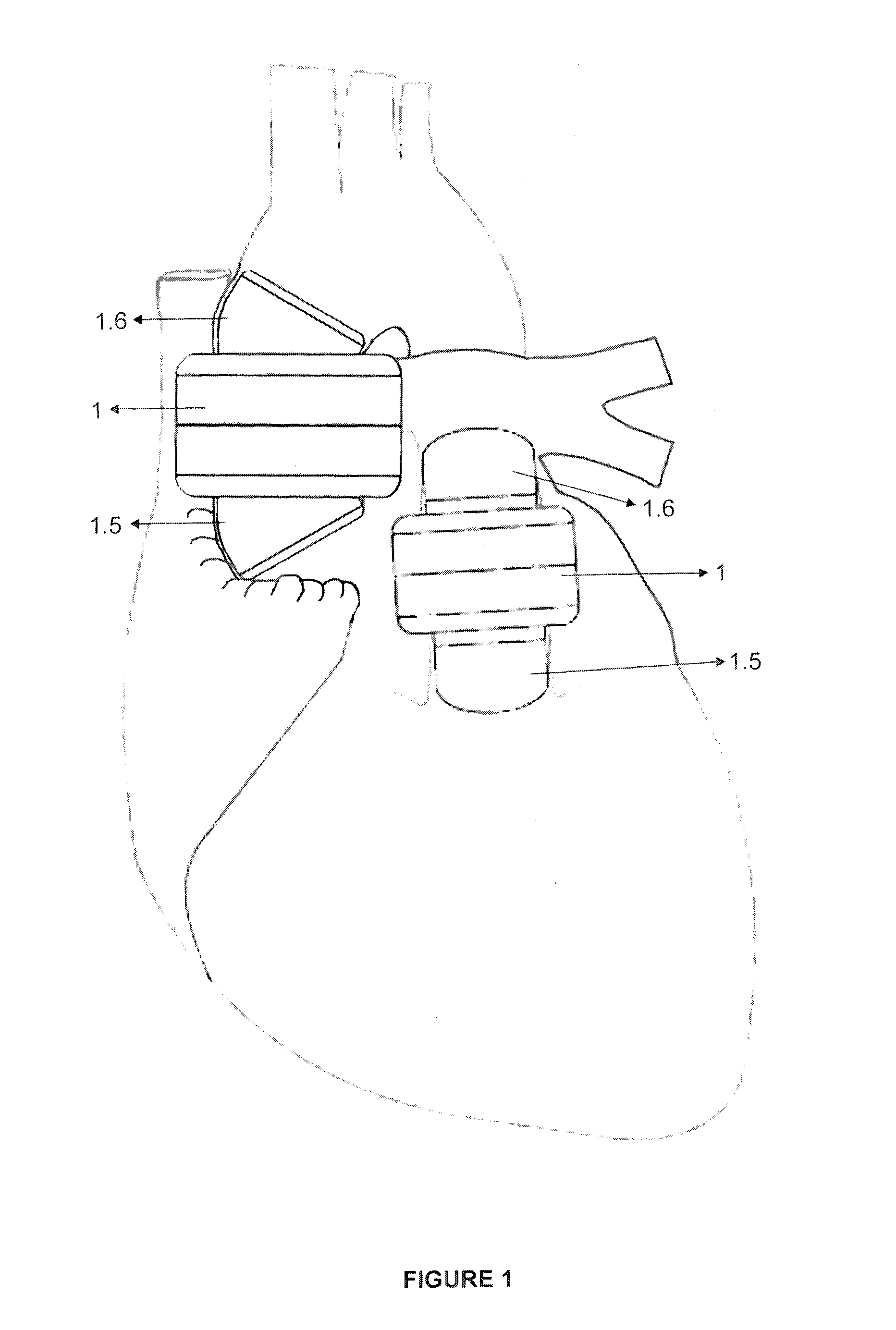 Trans arterial permanent heart assist device with double stators