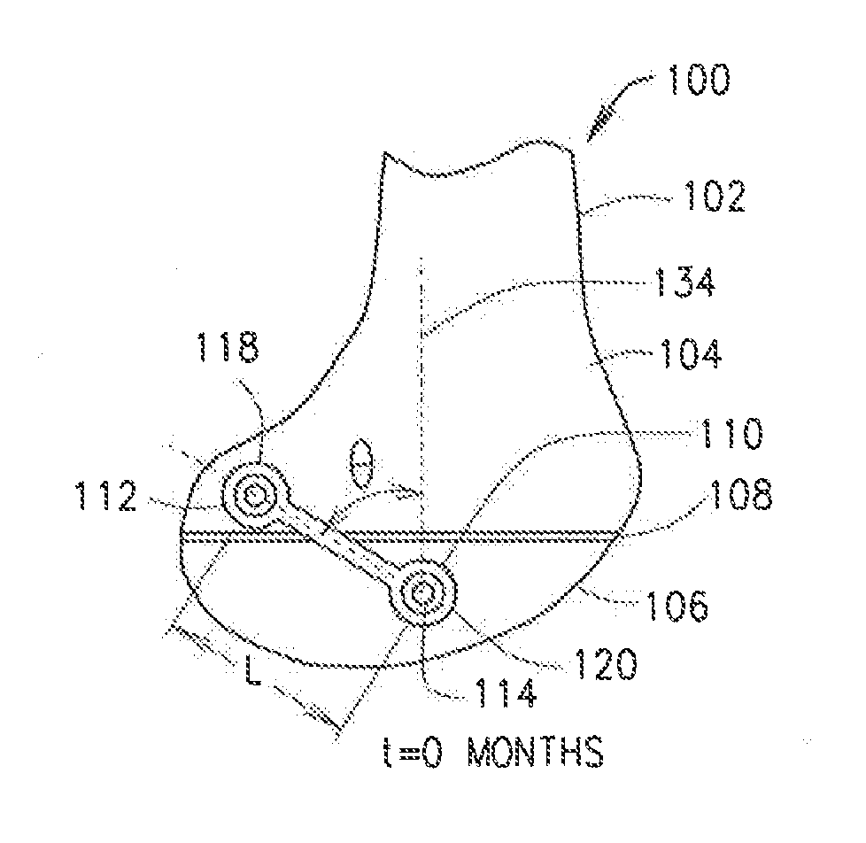 Systems and methods for correcting a rotational bone deformity