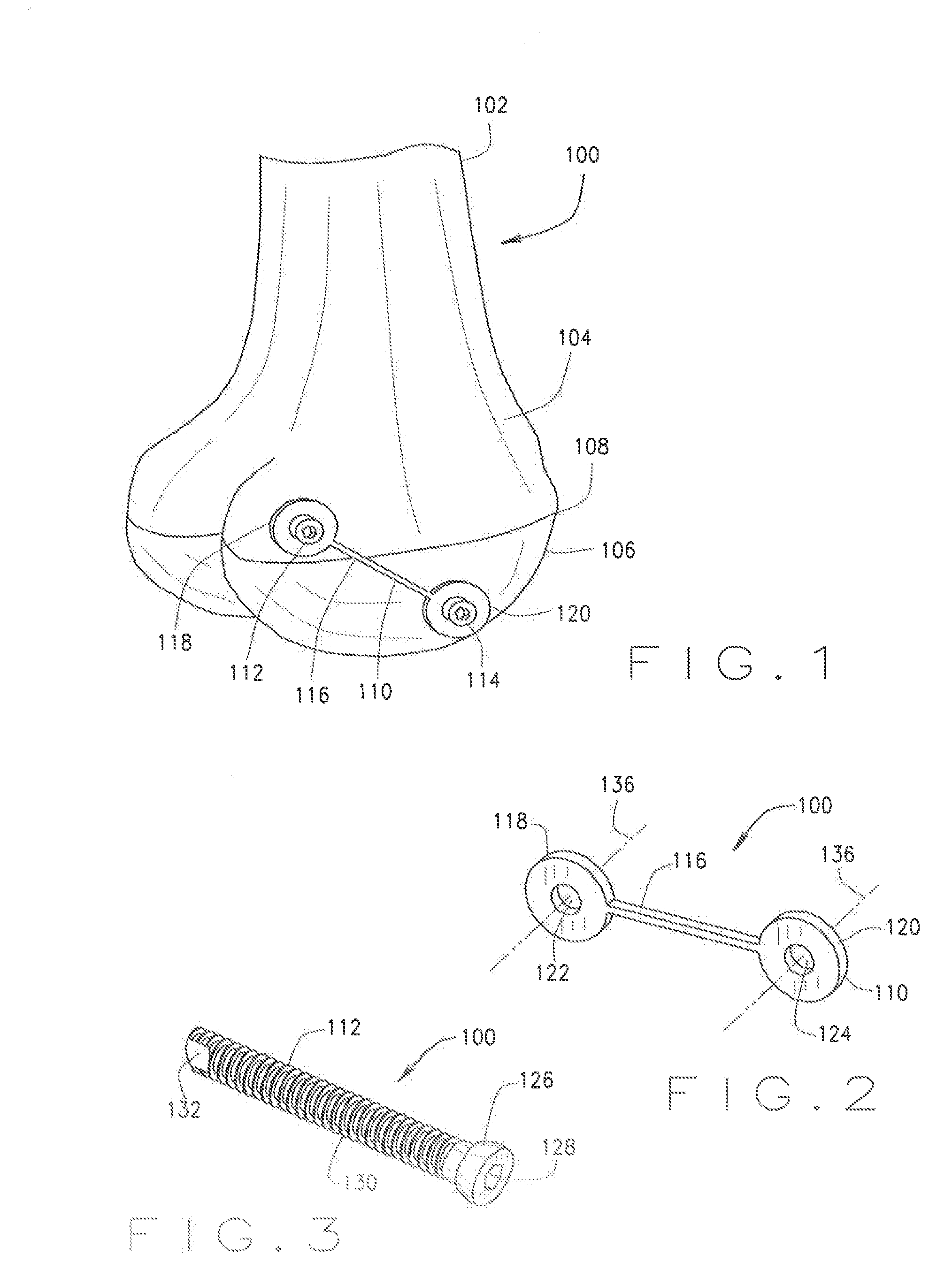 Systems and methods for correcting a rotational bone deformity