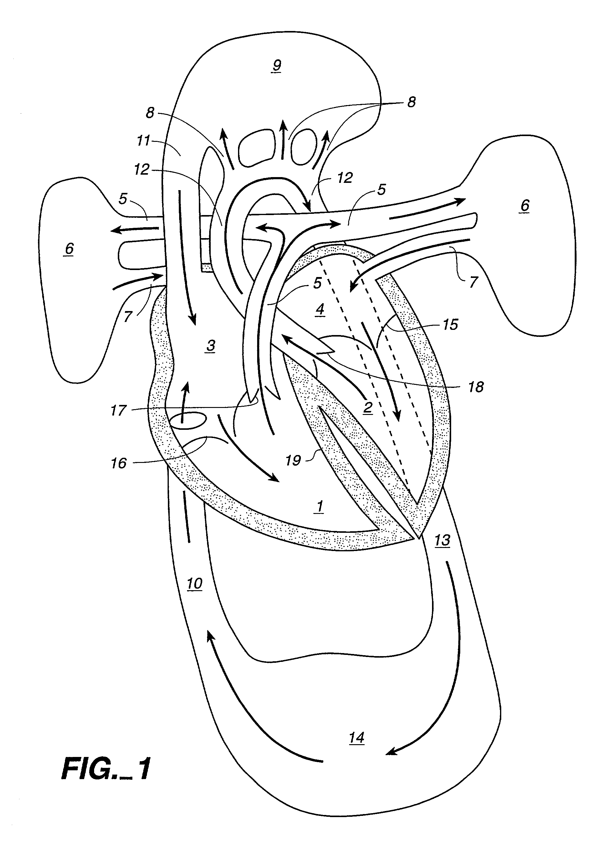 Multichannel catheter