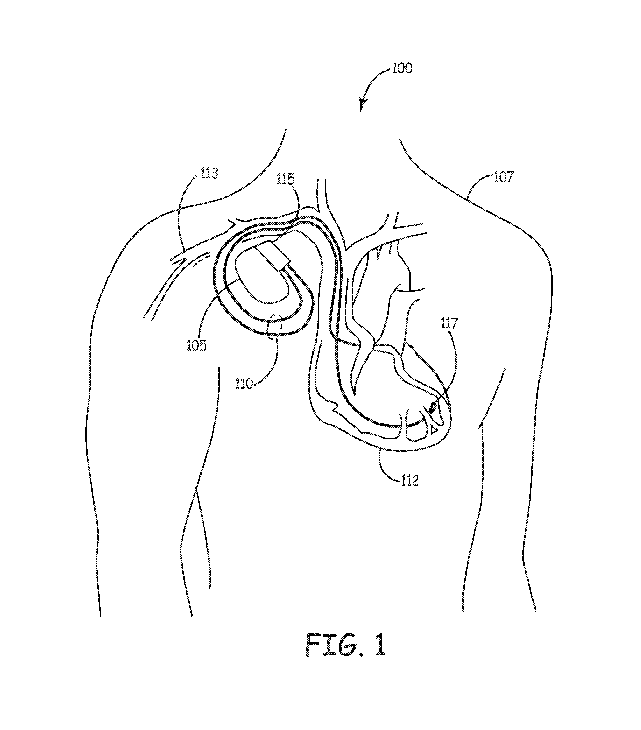 Methods and apparatus for reducing deleterious effects of x-ray radiation upon implantable medical device circuitry