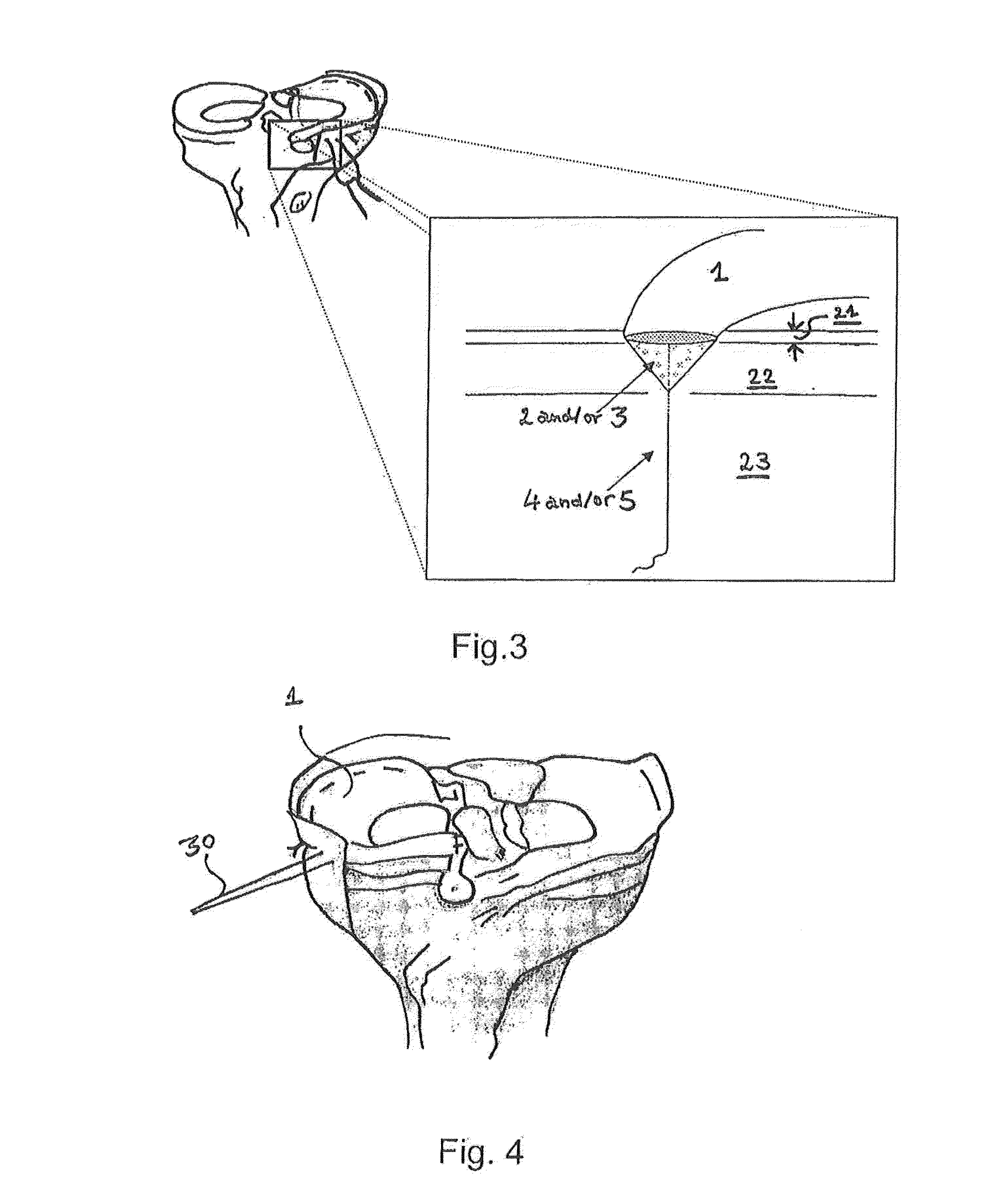 Non-resorbable meniscus prosthesis for the human knee joint