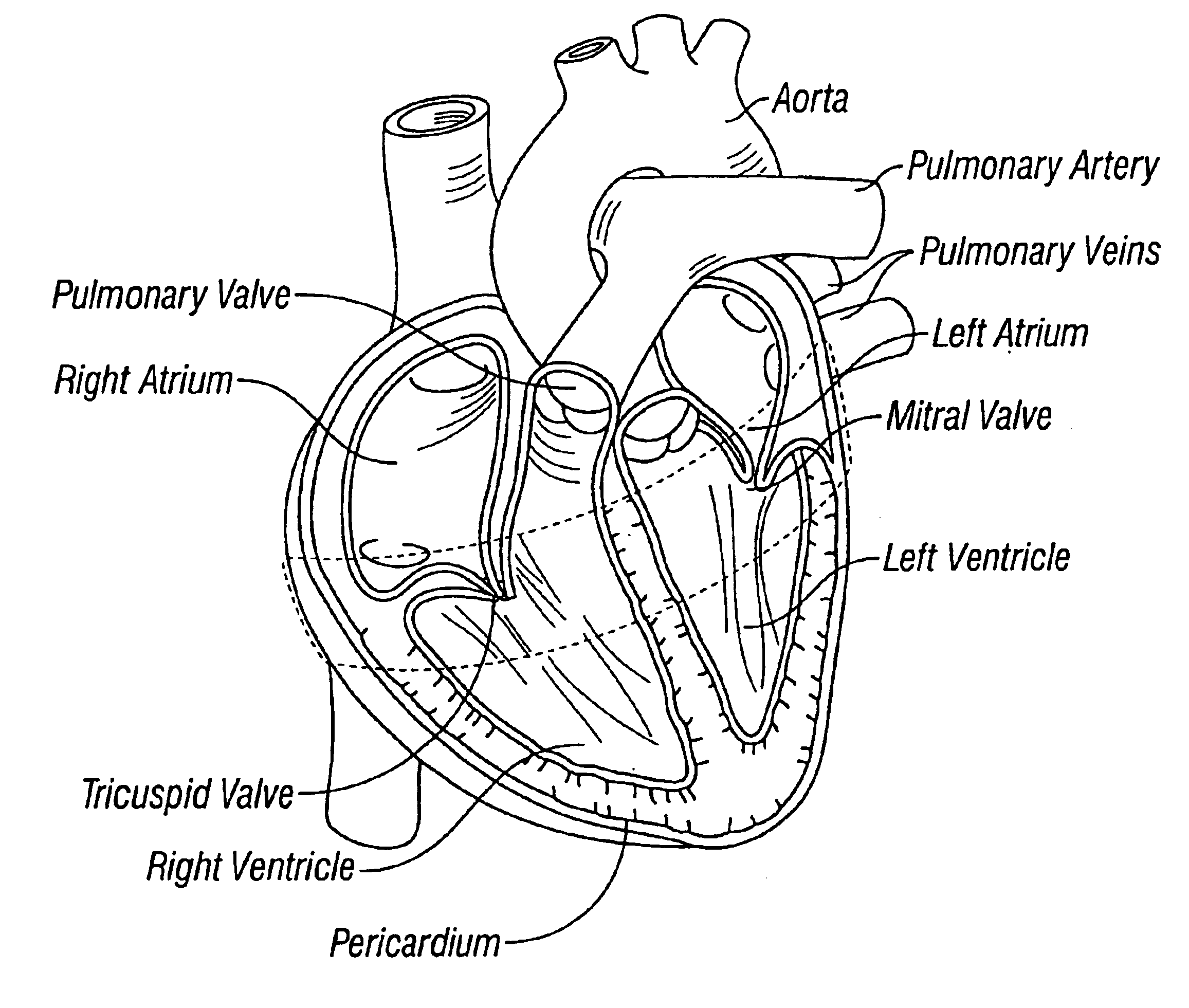 Method and apparatus for external stabilization of the heart