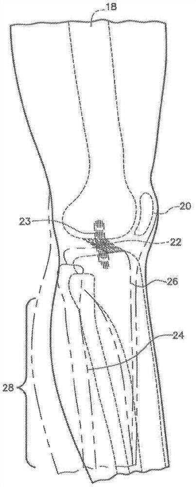 Cable knee brace system