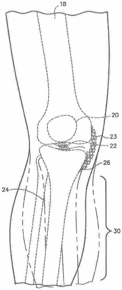 Cable knee brace system