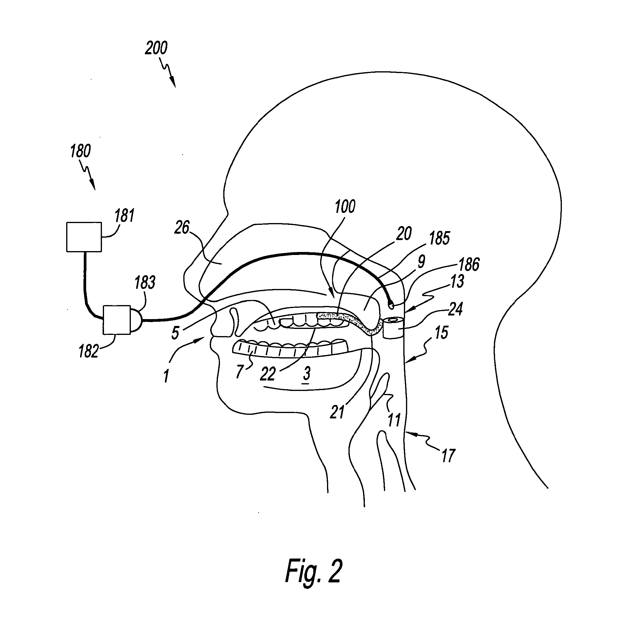 A palate retainer with attached nasopharyngeal airway extender for use in the treatment of obstructive sleep apnea