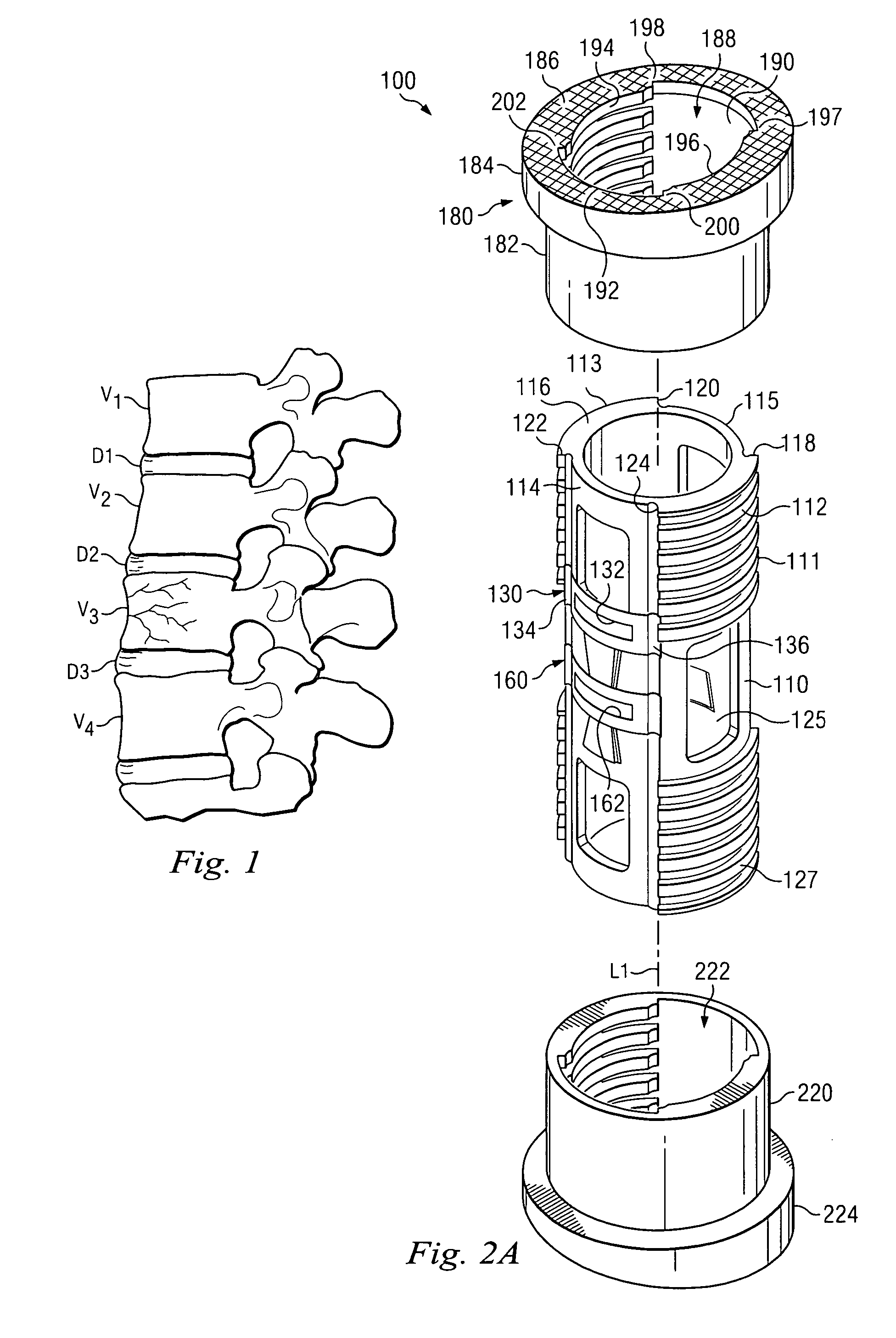 Locking expandable implant and method