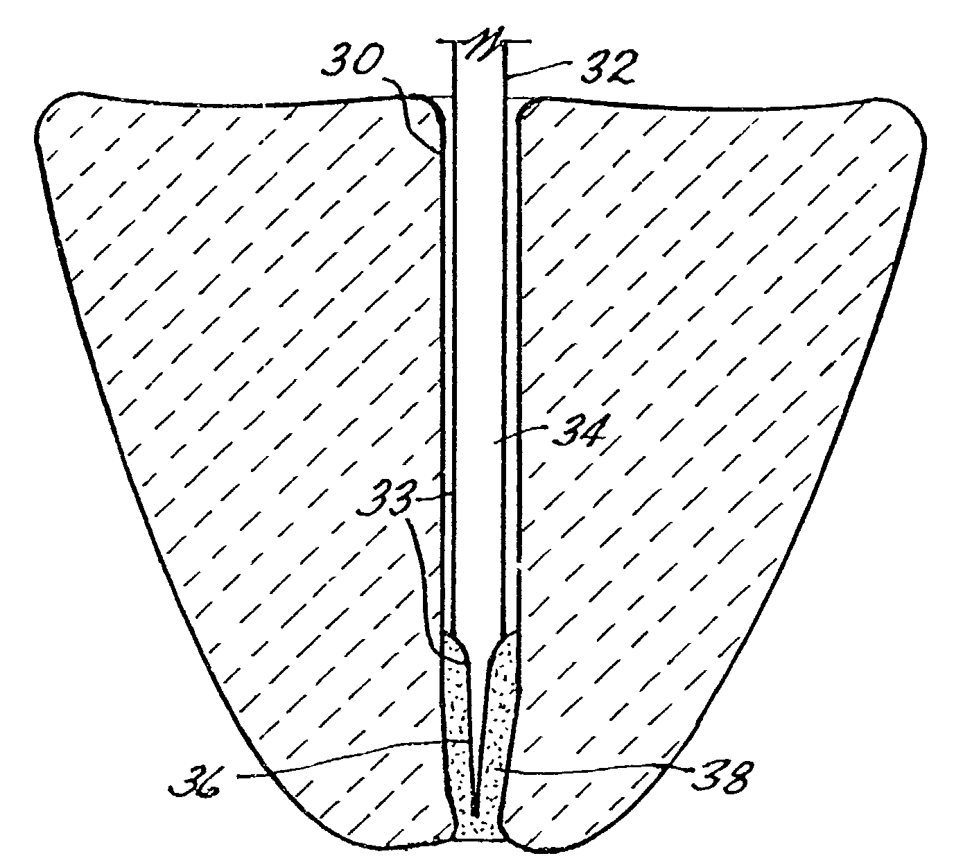 Endodontic post system