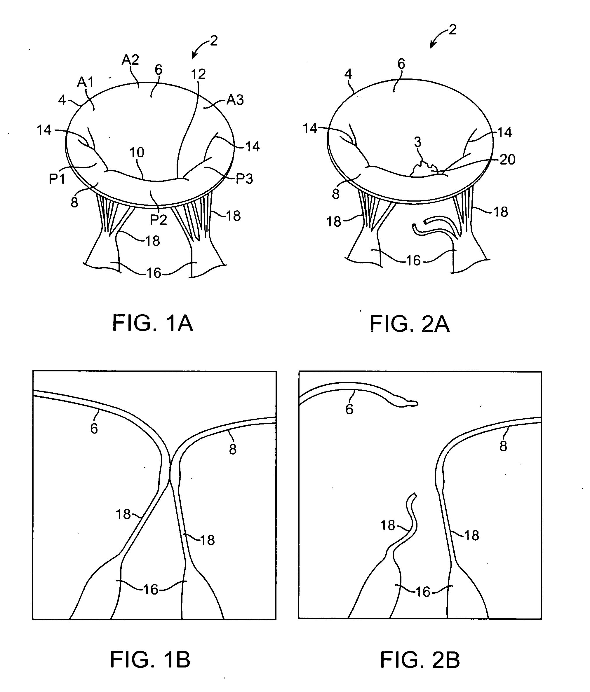 Devices and methods for repairing cardiac valves