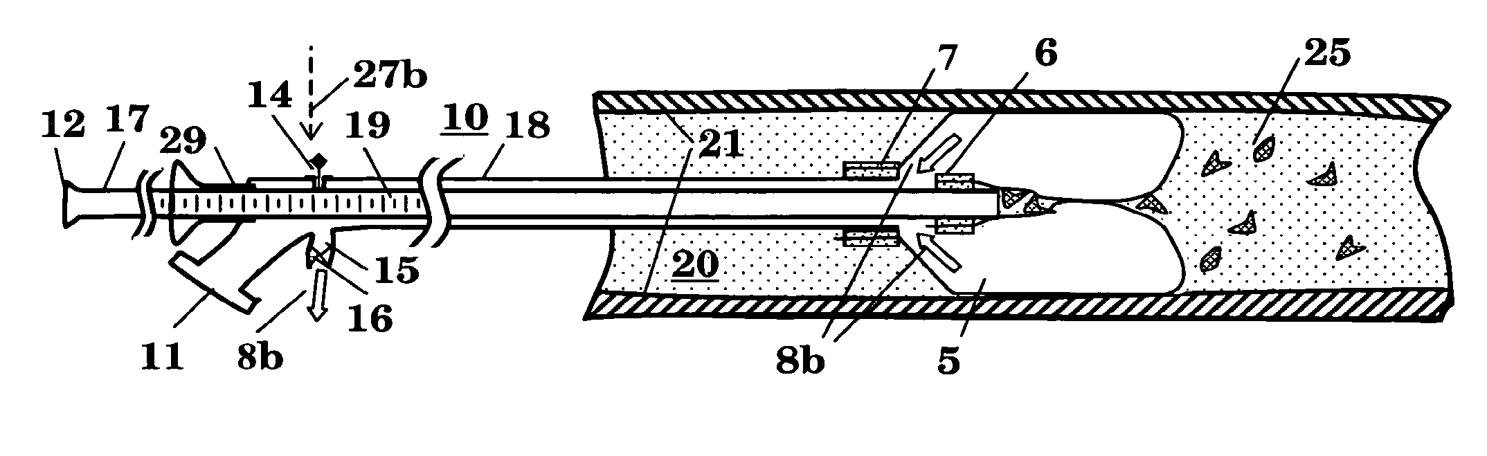 Balloon catheter