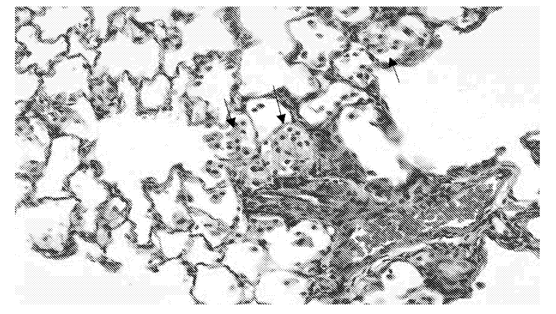 Use of C5A receptor antagonist in the treatment of fibrosis