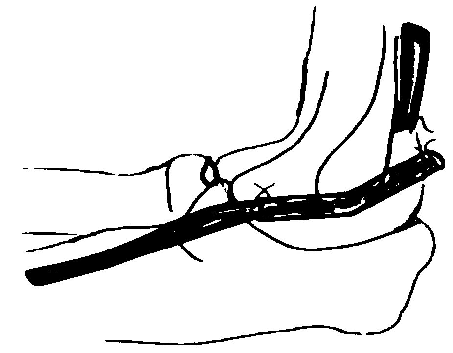 Flexible peripheral neurological deficit repairing duct and preparation method thereof