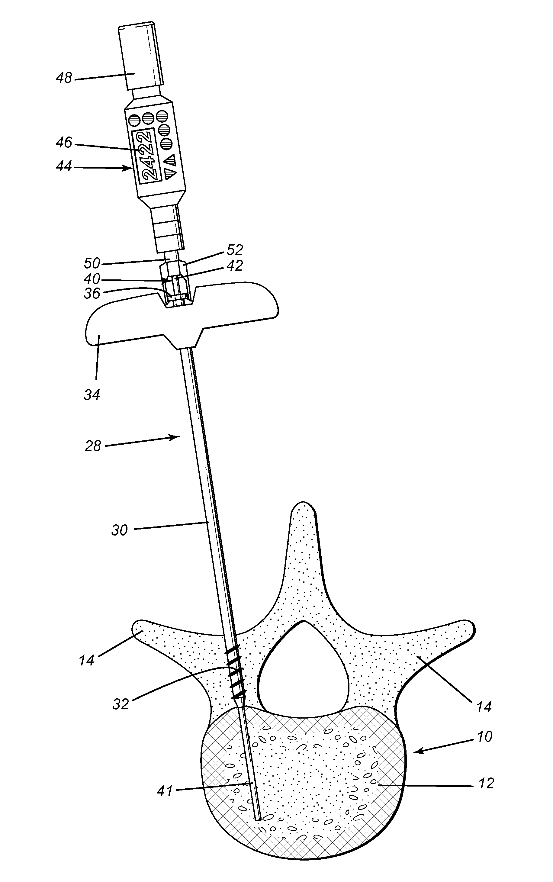 Minimally invasive method and applications for injectible materials