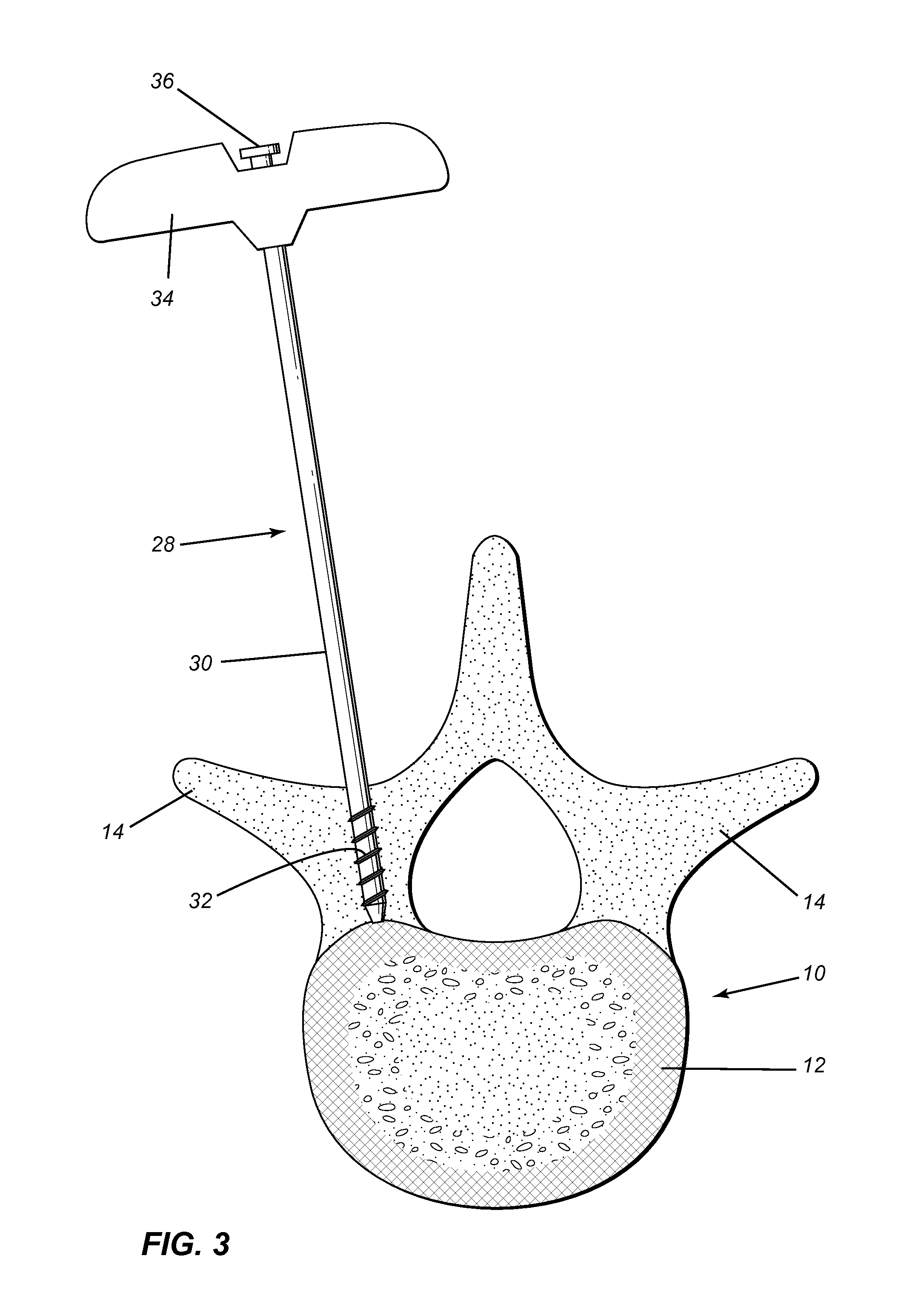 Minimally invasive method and applications for injectible materials