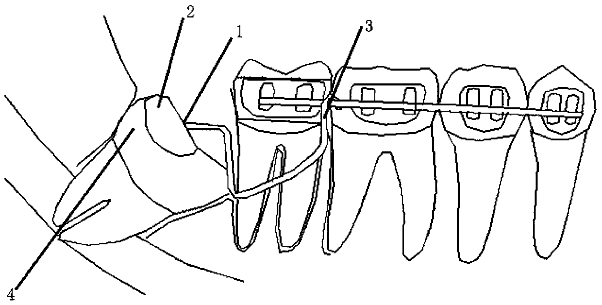 Titanium alloy embedded tooth individual traction accessory printed through three-dimensional technology