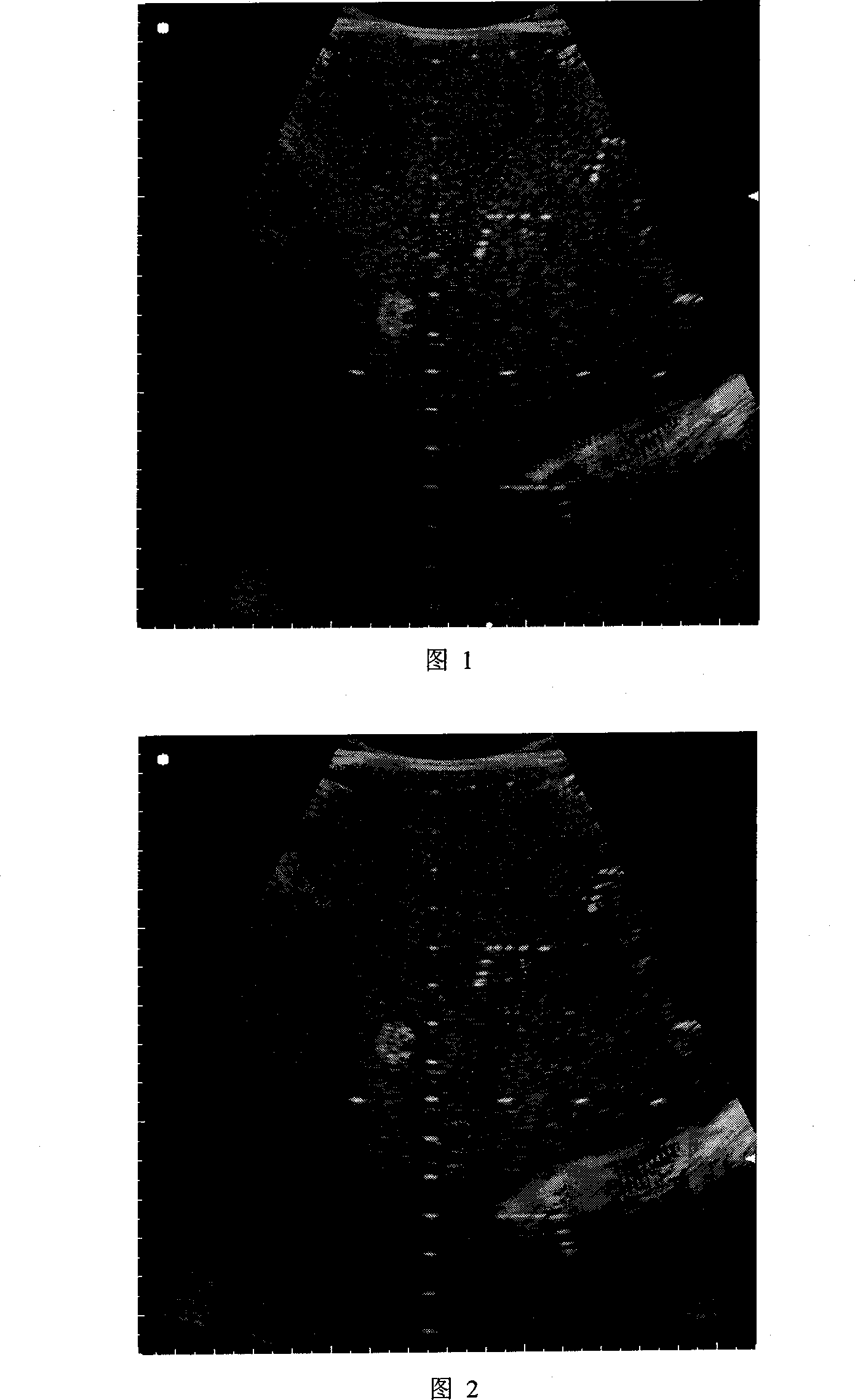 Method for connecting multi focal medical ultrasonic echogram