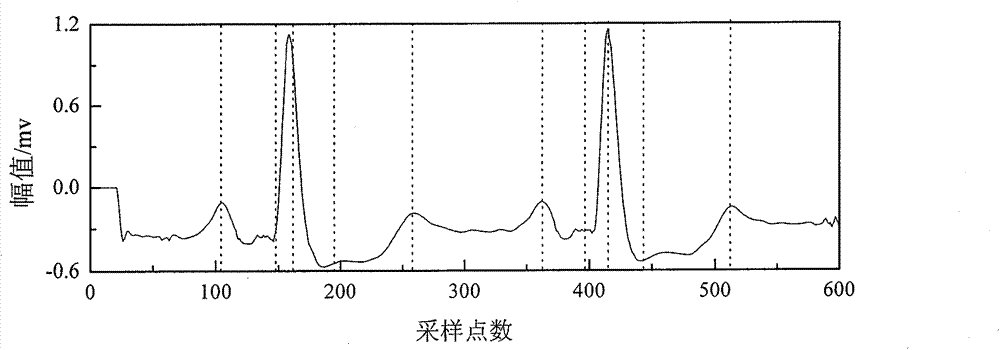 Electrocardiosignal characteristic detection algorithm