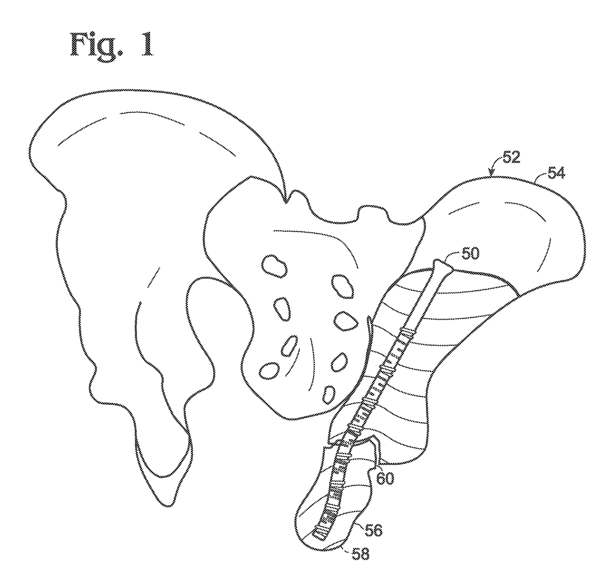 Steerable fastener for bone