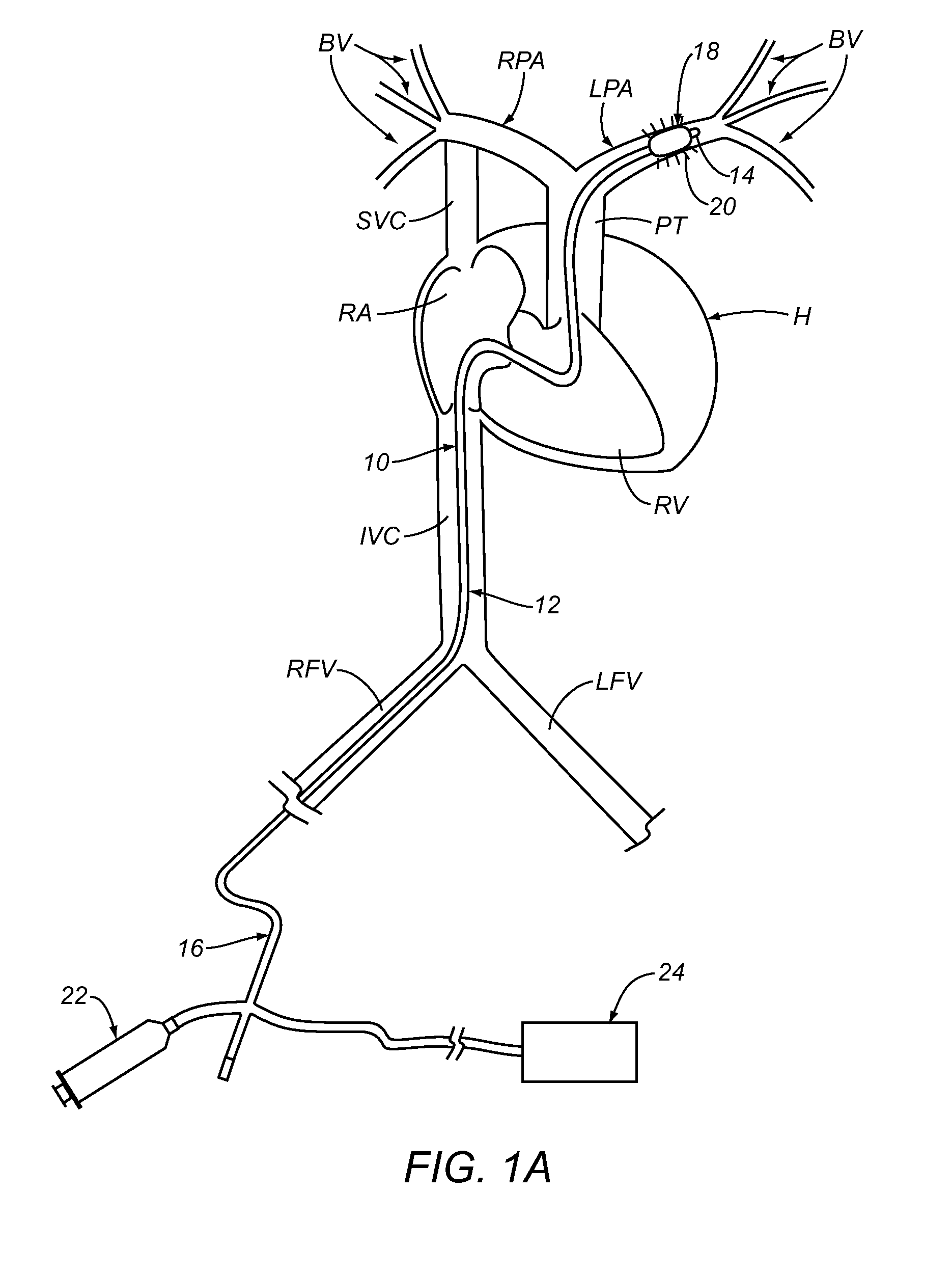 Apparatus and methods for treating pulmonary hypertension