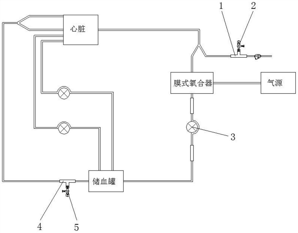 Novel extracorporeal circulation ultrafiltration pipeline