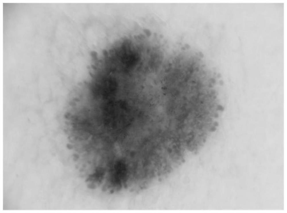 Skin lesion segmentation and feature extraction method based on deep residual pyramid