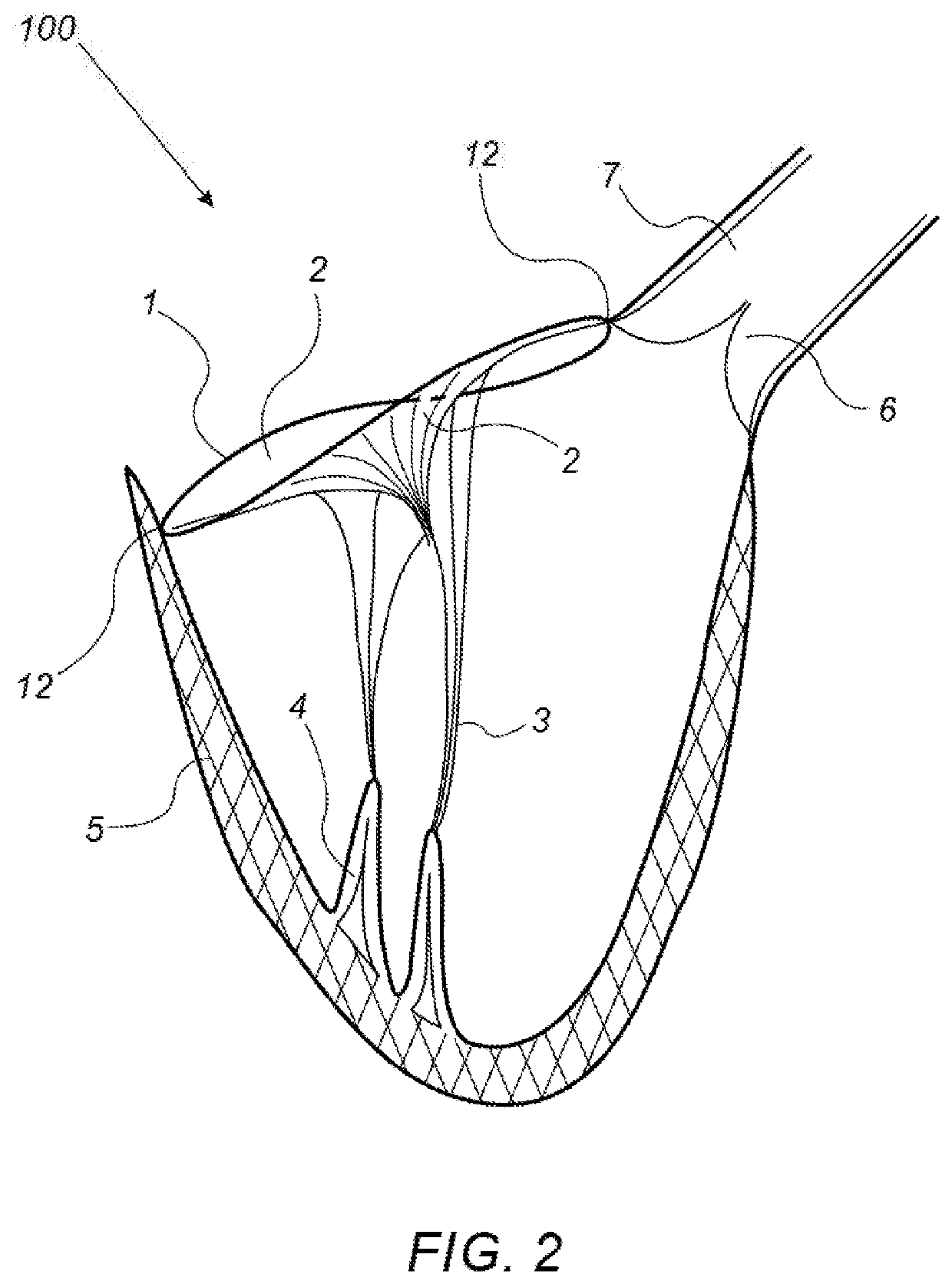 Naturally designed mitral prosthesis