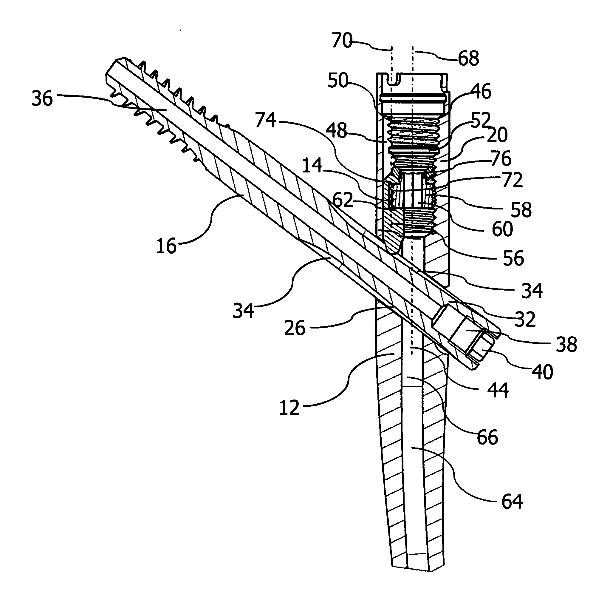 Implant system for bone fixation