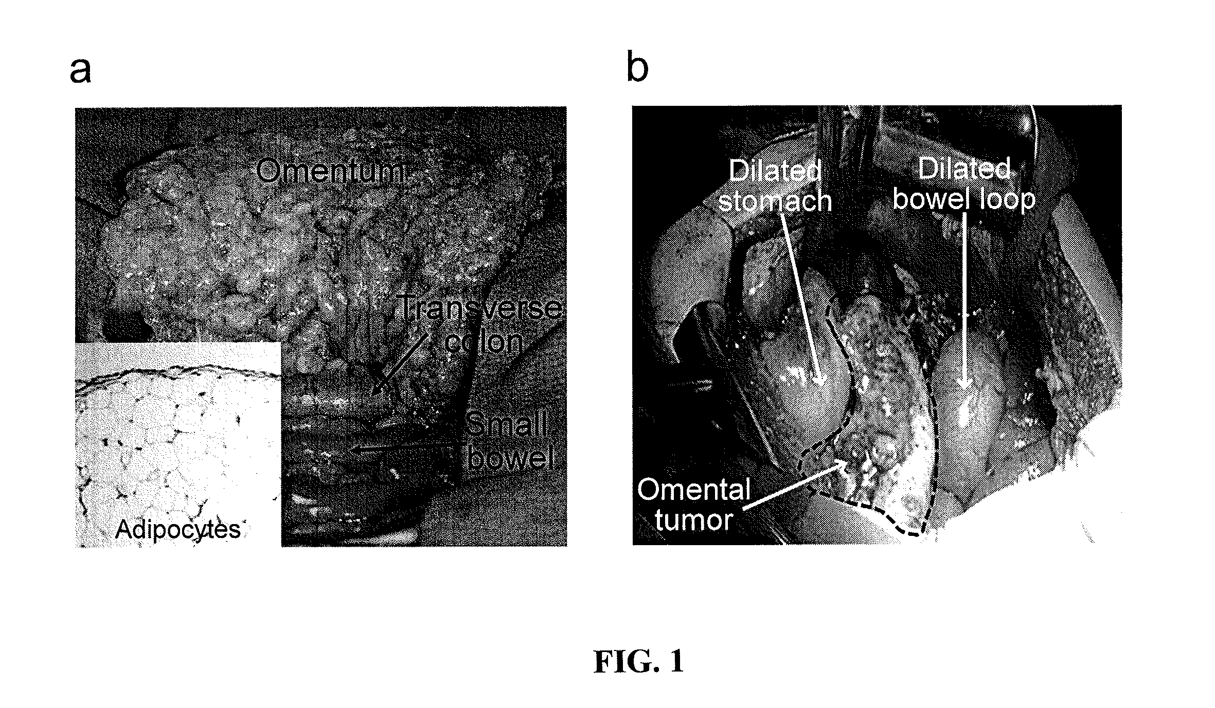 Compositions and methods for treating and/or preventing cancer by inhibiting fatty acid binding proteins