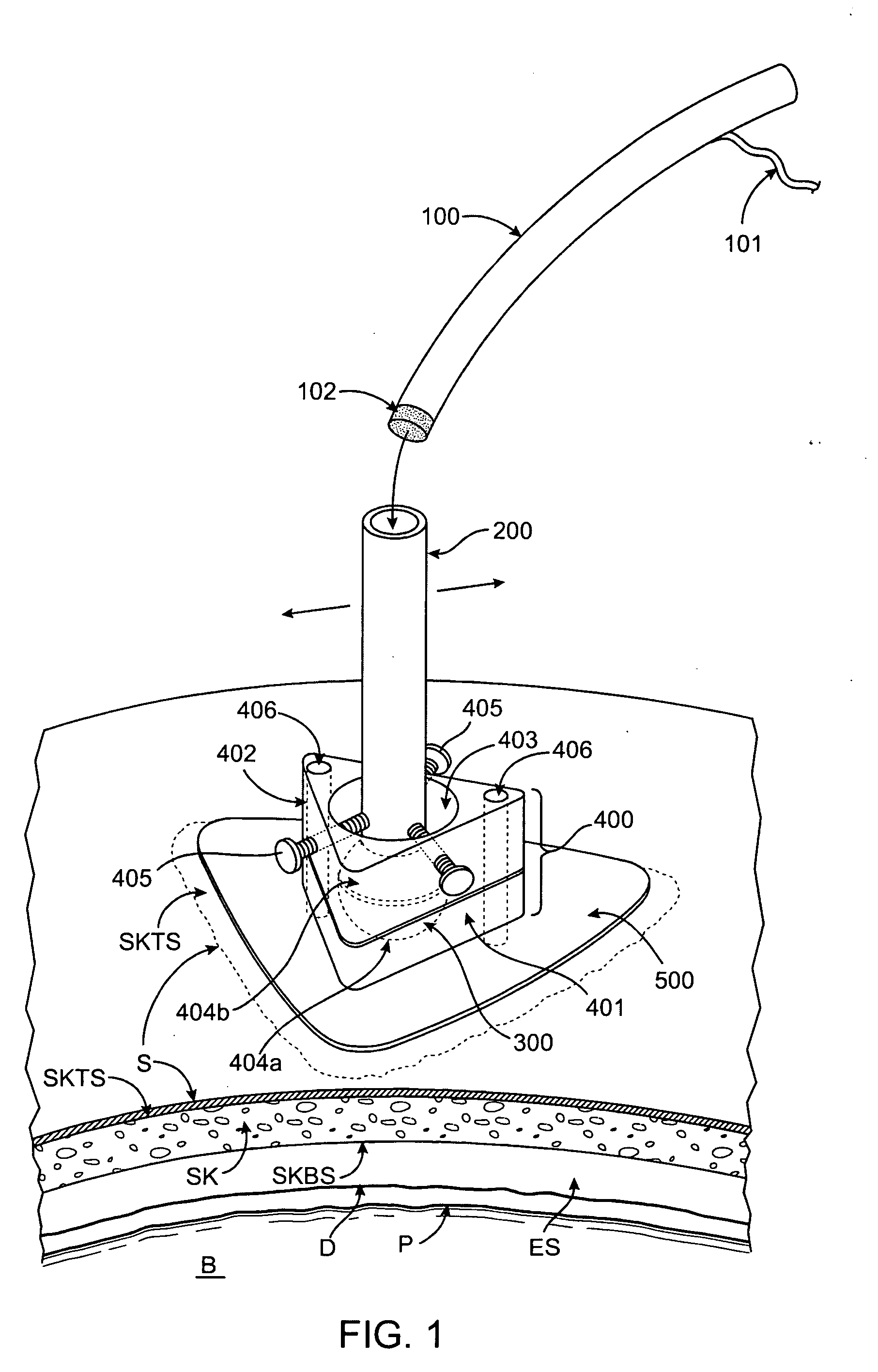 Methods and apparatus for intracranial ultrasound therapies