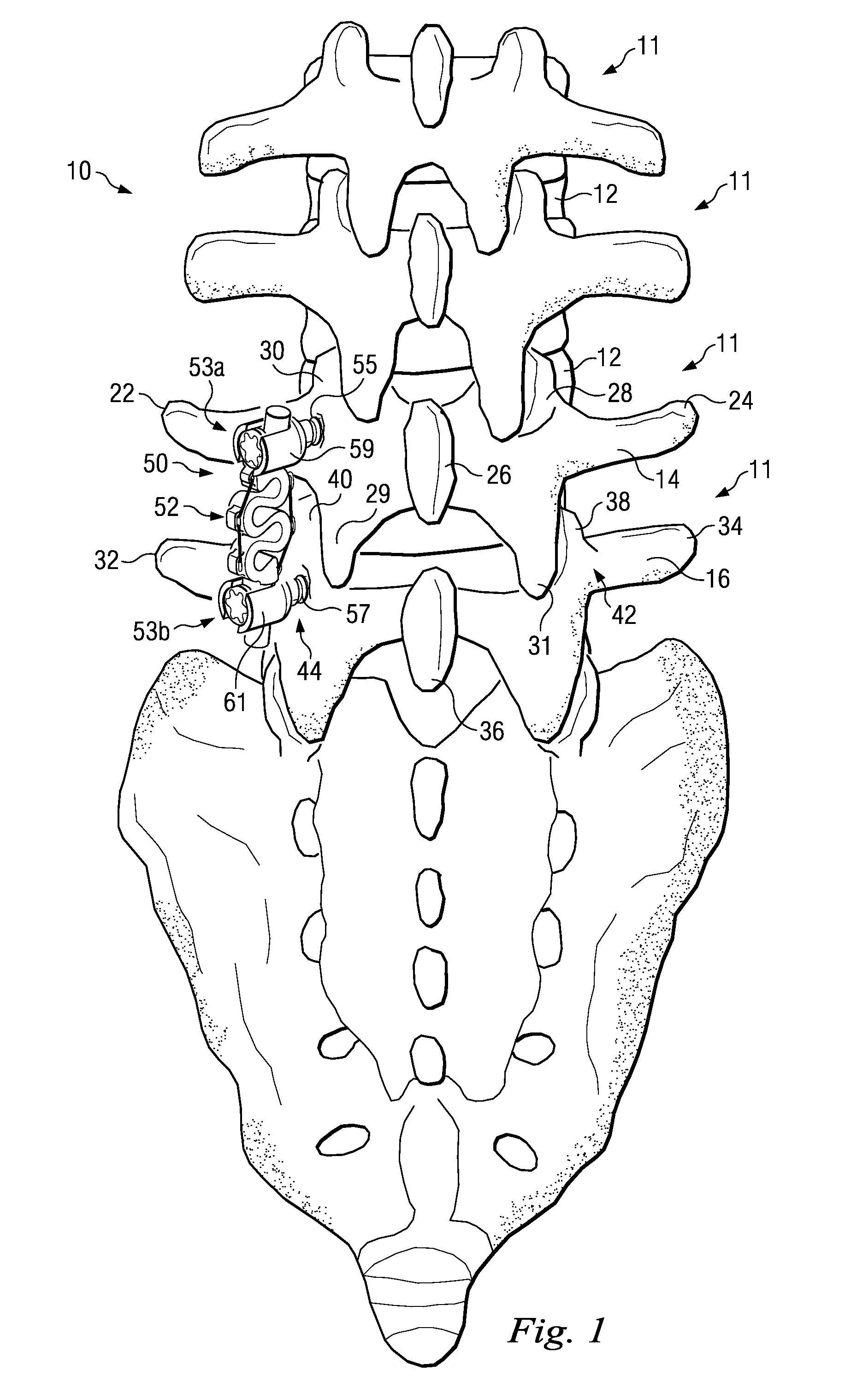 Vertebral Stabilizer