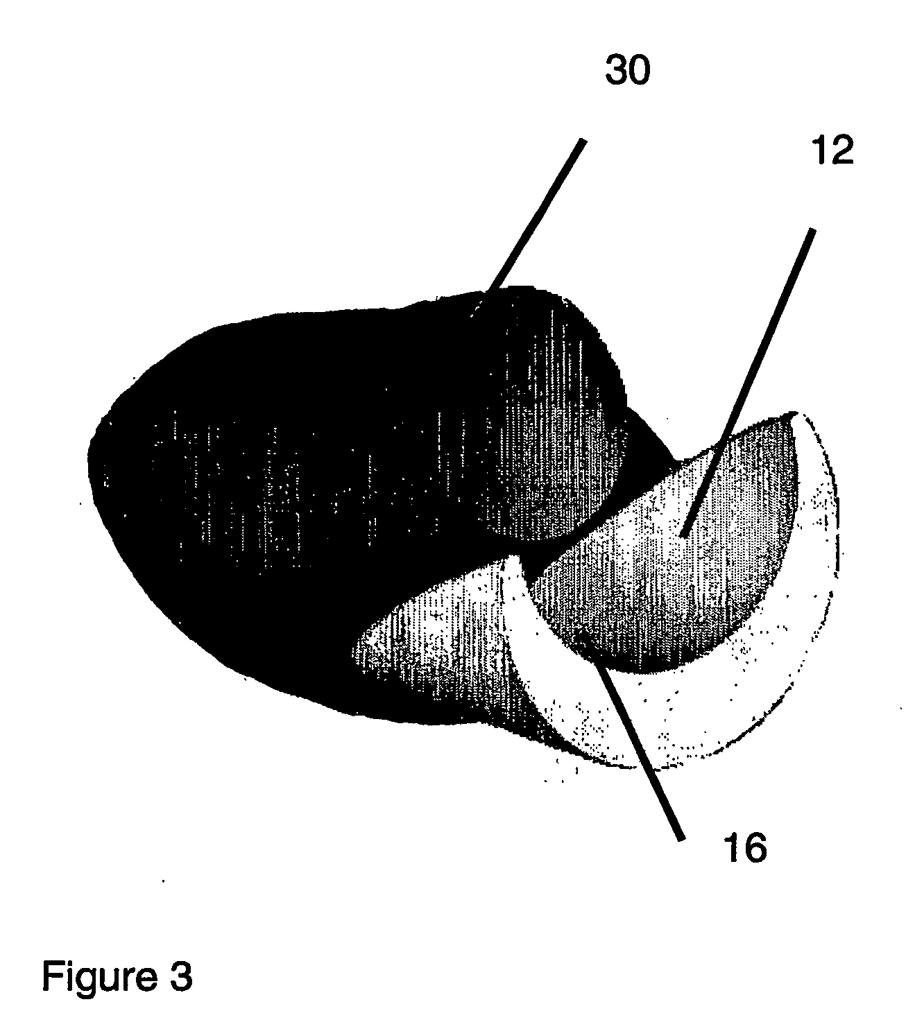 Hernia prosthesis