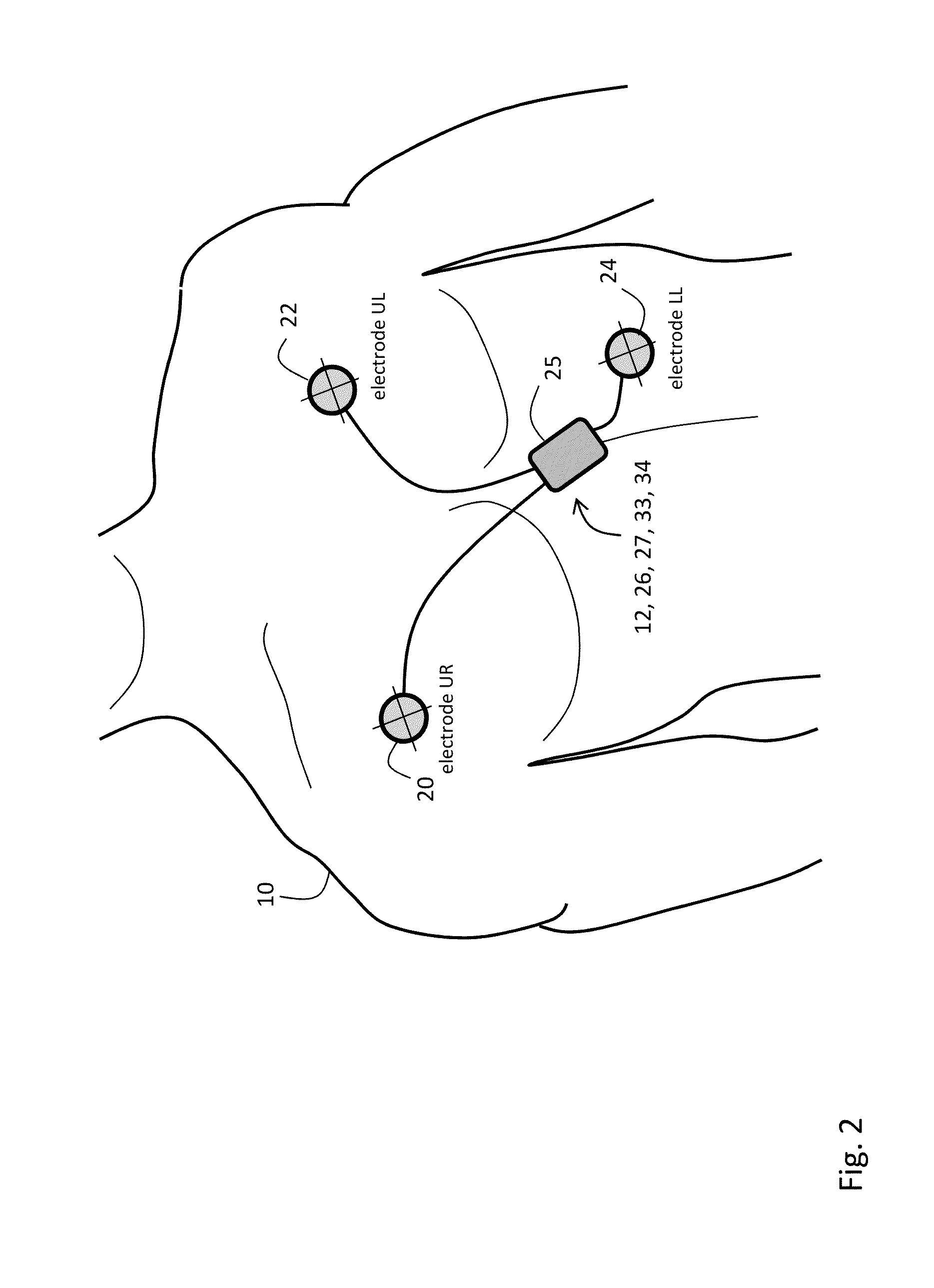 Body-worn monitor for measuring respiratory rate