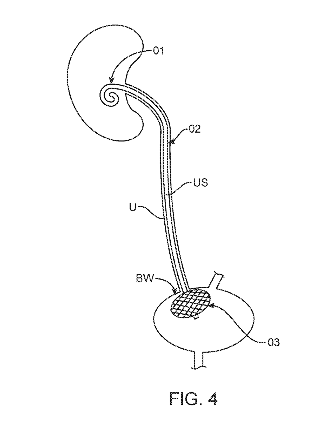 Ureteral stent with a non-irritating and shock-absorbing bladder anchor