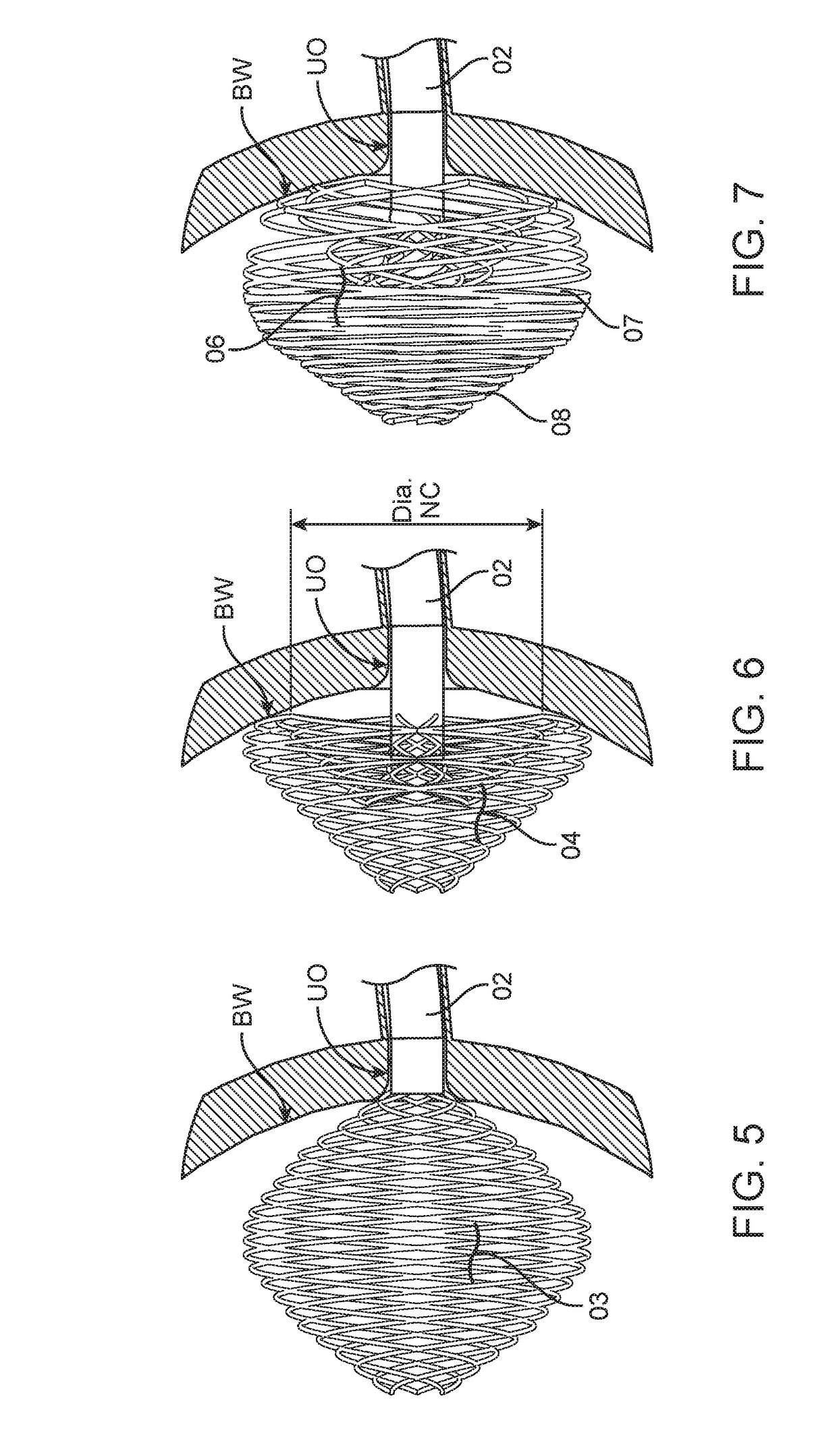 Ureteral stent with a non-irritating and shock-absorbing bladder anchor