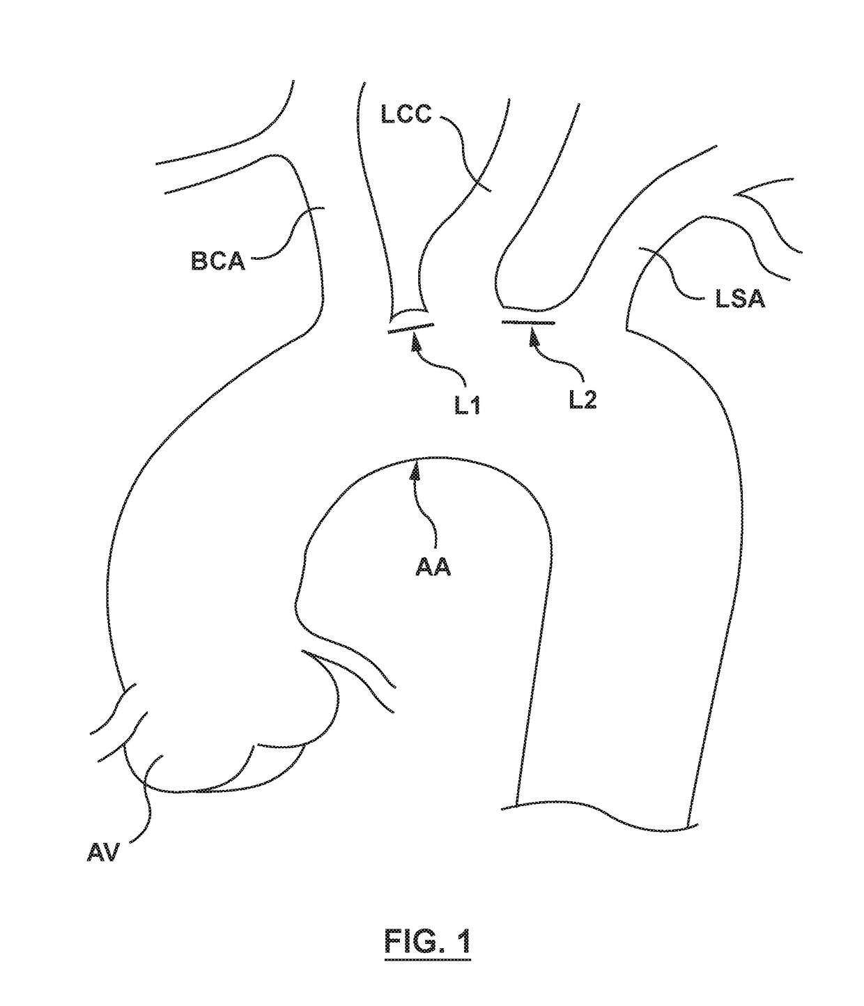 Modular aortic arch prosthetic assembly and method of use thereof