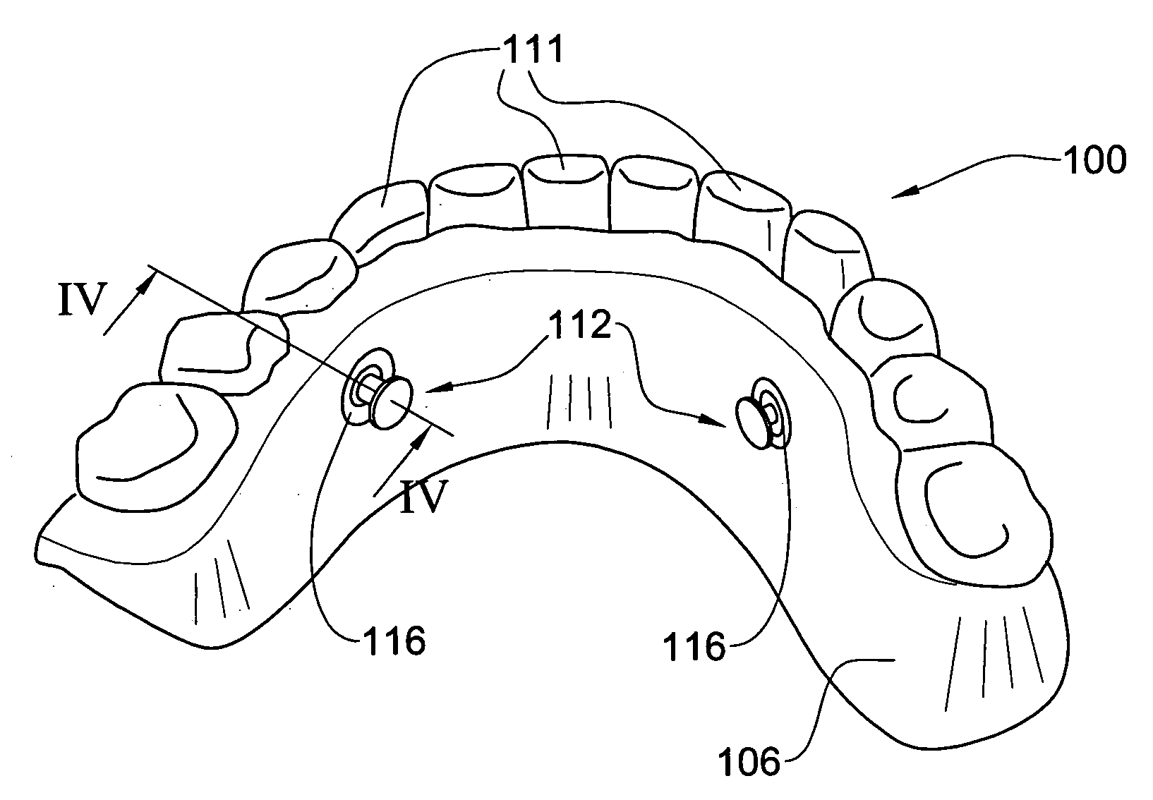 Method and system for fixing removable dentures