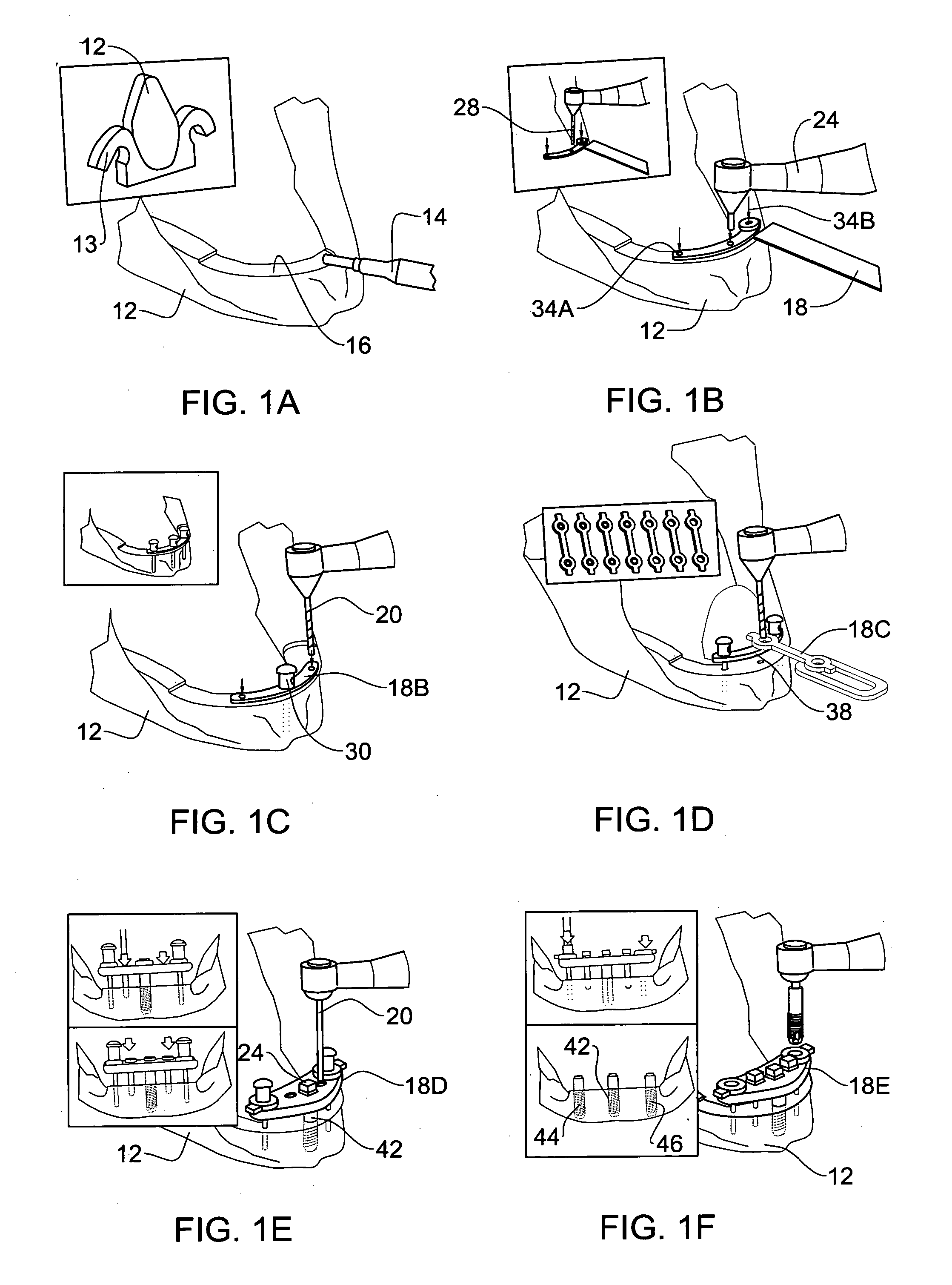 Method and system for fixing removable dentures