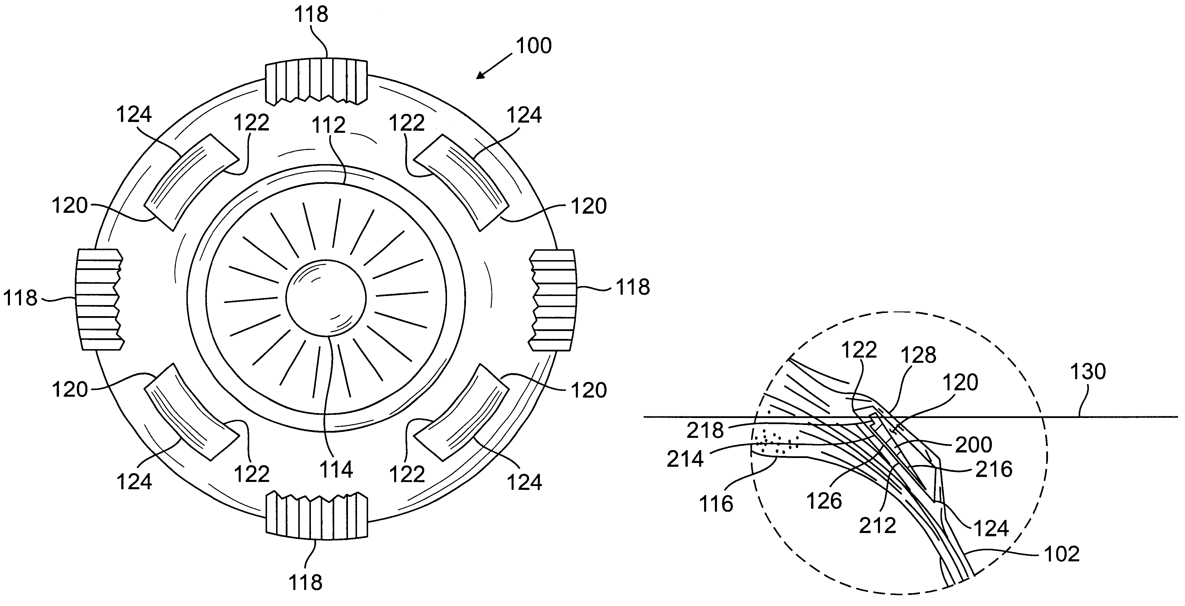 Scleral prosthesis for treatment of presbyopia and other eye disorders