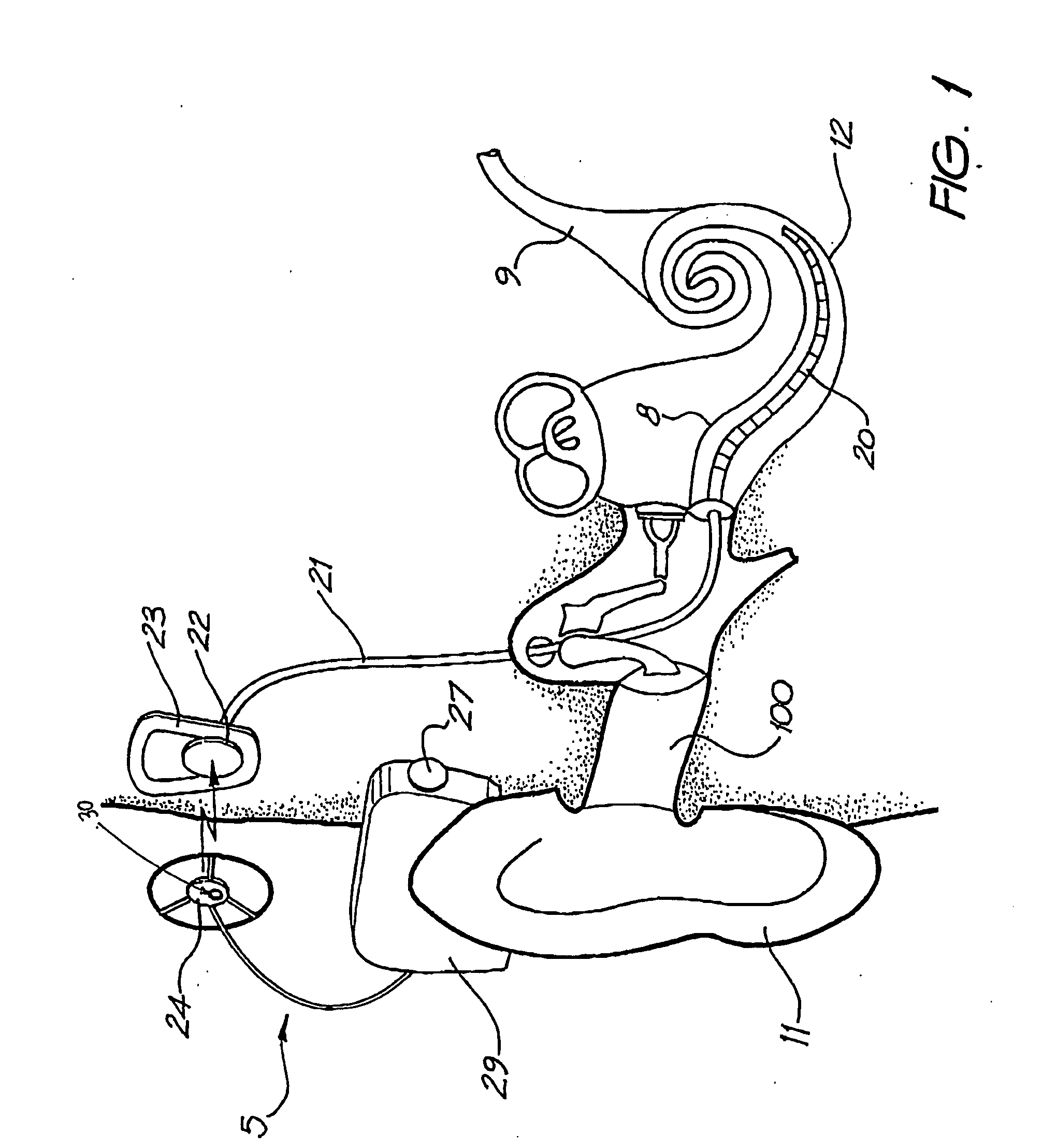 Monitor for auditory prosthesis