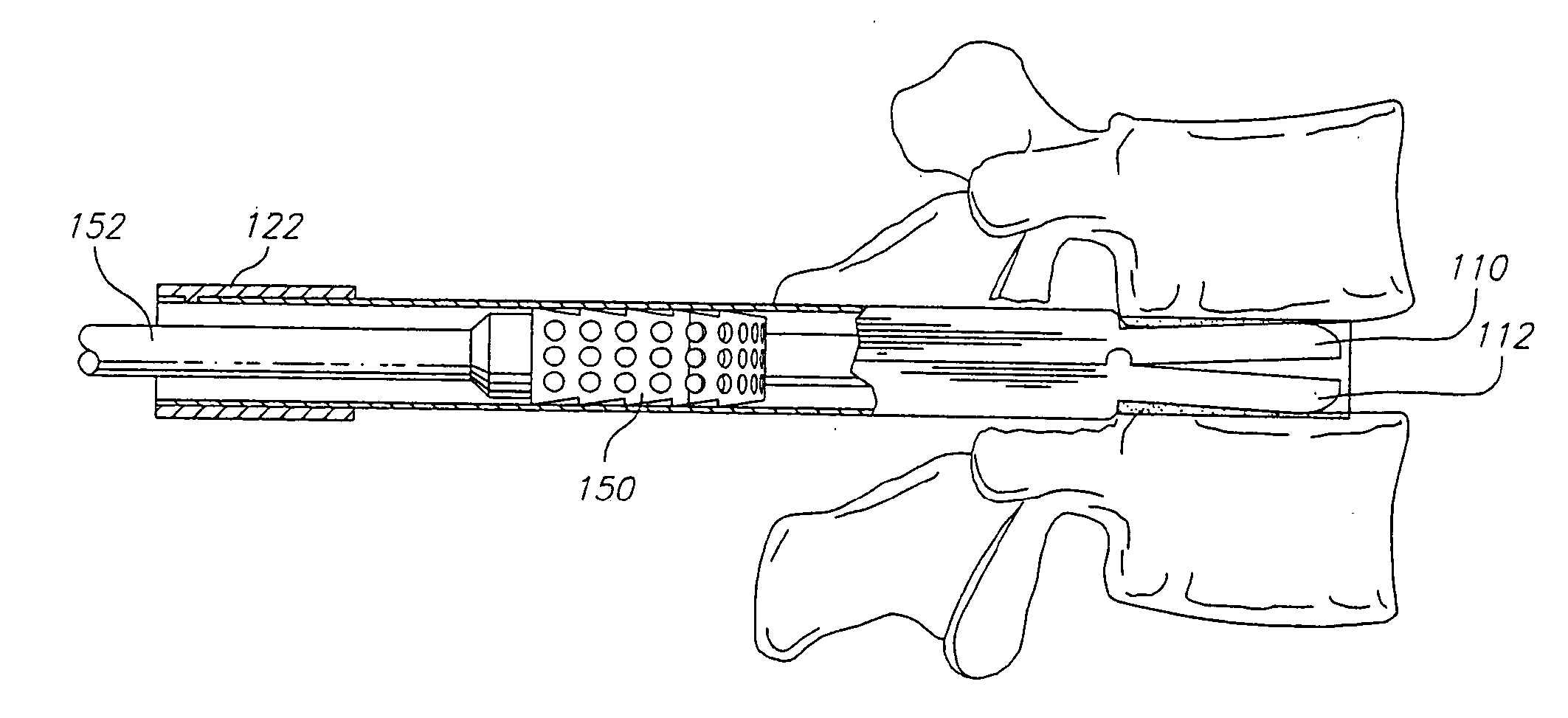 Method for using dynamic lordotic guard with movable extensions for creating an implantation space posteriorly in the lumbar spine