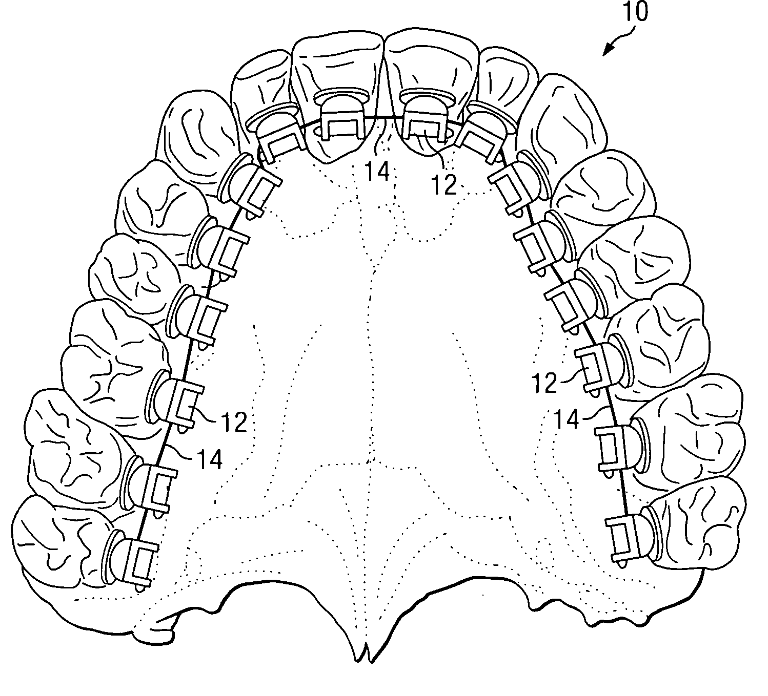 Self-ligating lingual orthodontic bracket