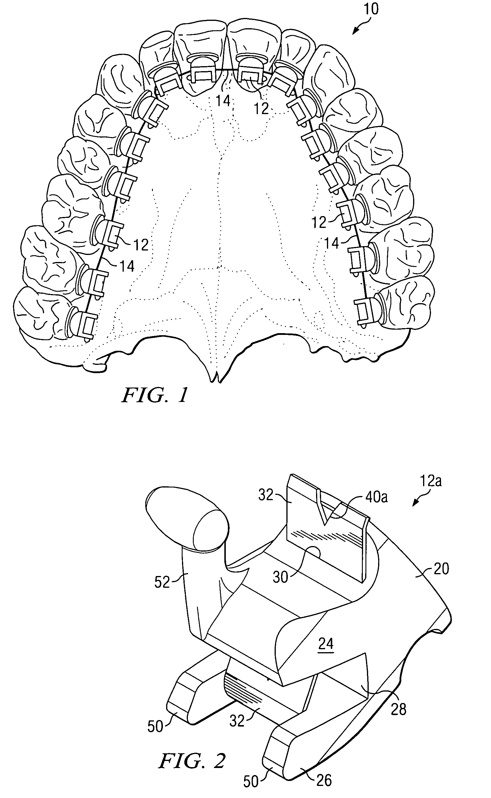 Self-ligating lingual orthodontic bracket