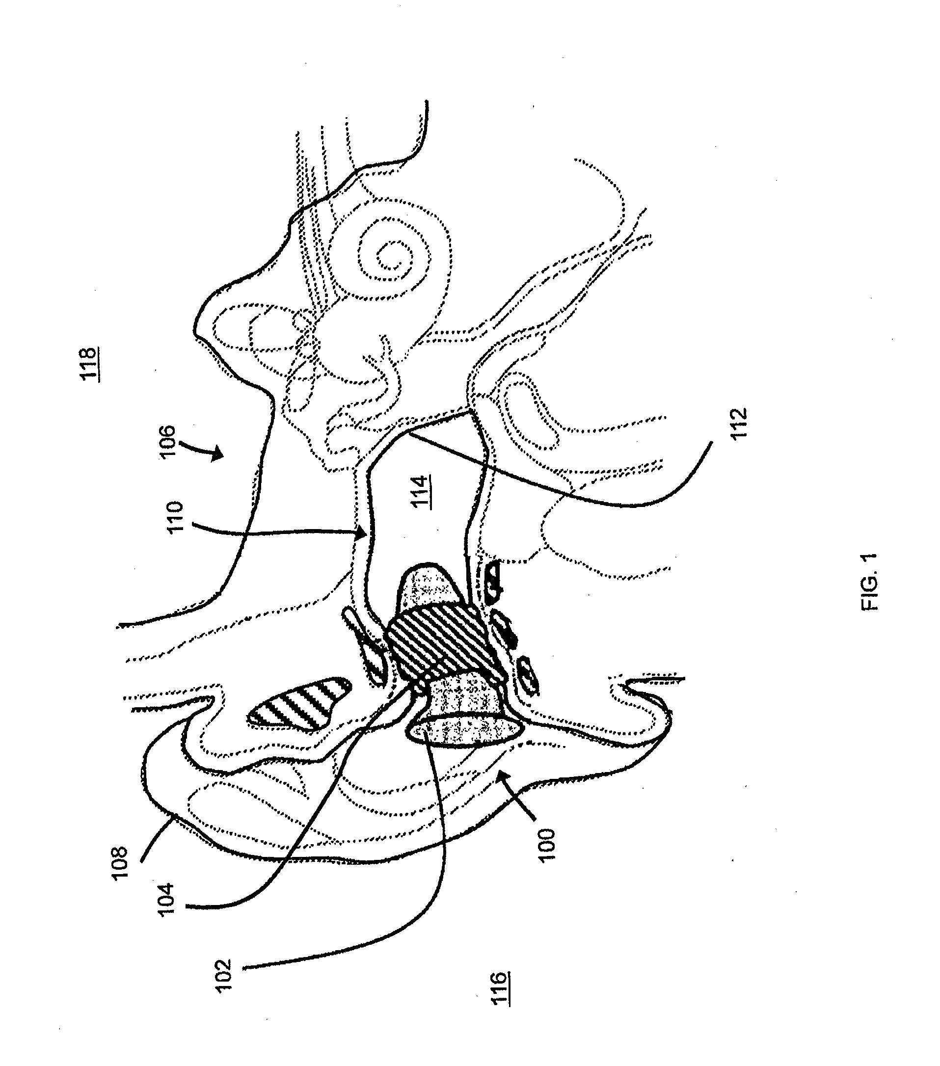 Methods and devices for radio frequency (RF) mitigation proximate the ear