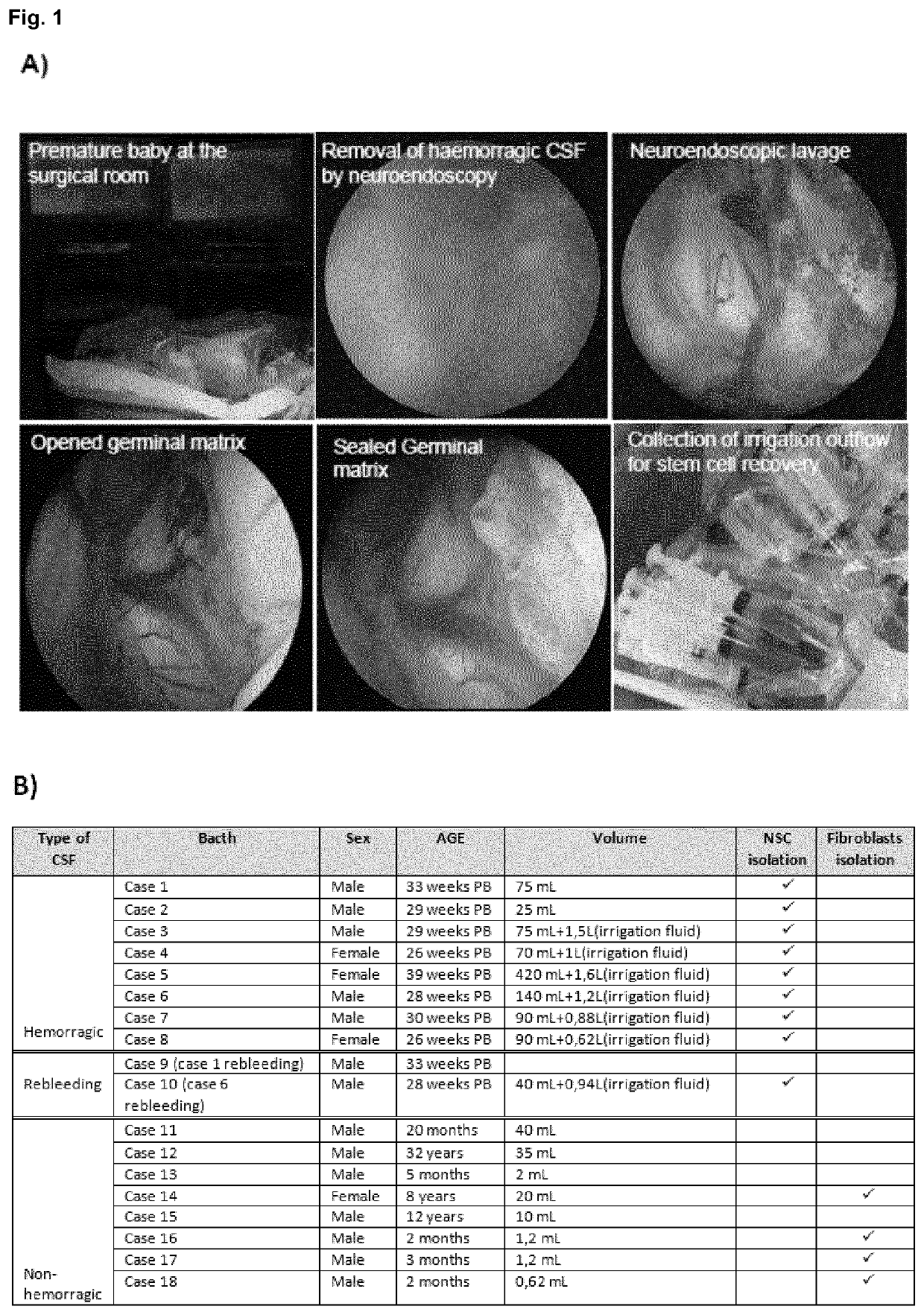 Hemorrhagic cerebrospinal fluid neural stem cells